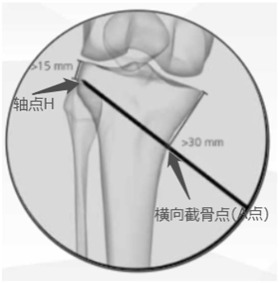 Planning method and device for tibia osteotomy intelligent navigation system