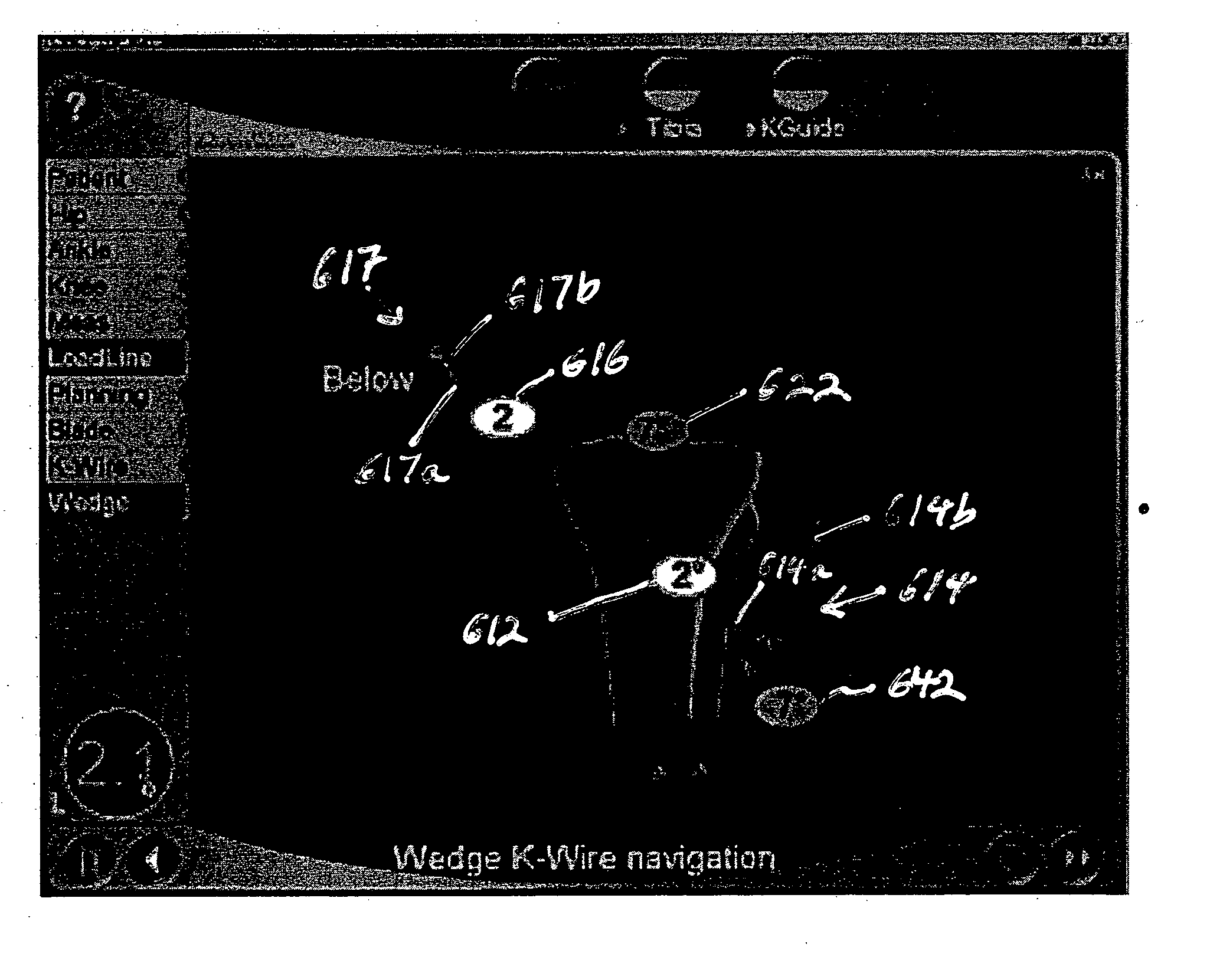 Method and apparatus for navigating a cutting tool during orthopedic surgery using a localization system