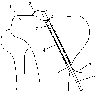 Minimally invasive fixation device for tibial intercondylar spine fracture