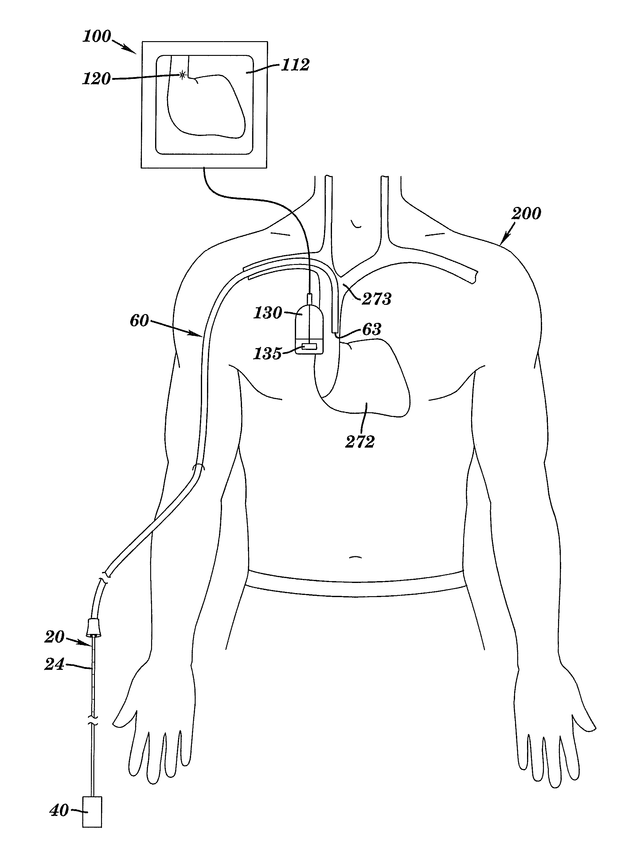 Methods, assemblies, and devices for positioning a catheter tip using an ultrasonic imaging system