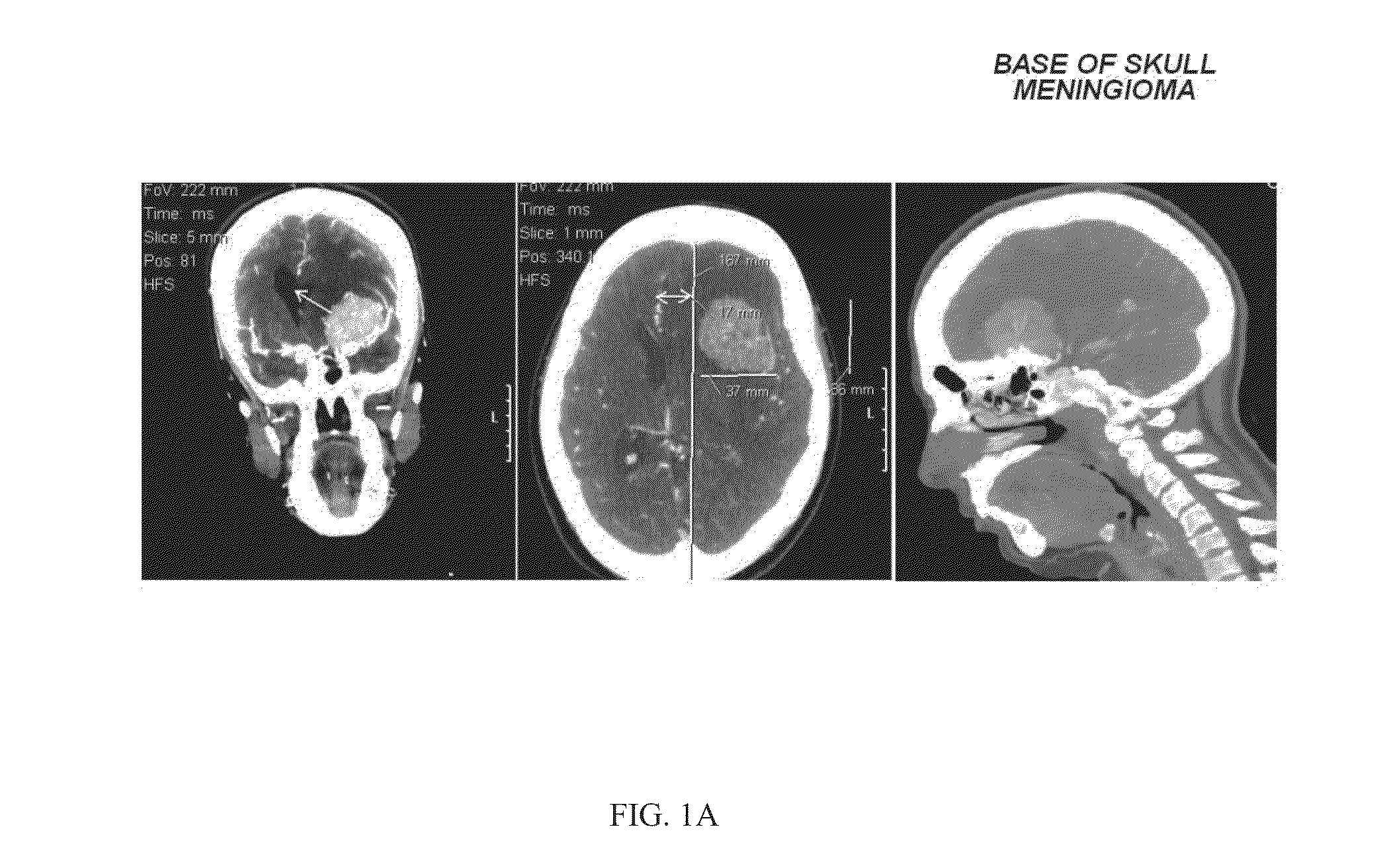 Halogenated aliphatic carboxylic acids, oligomers and/or polymers thereof and their use in devitalizing external and internal neoplasms