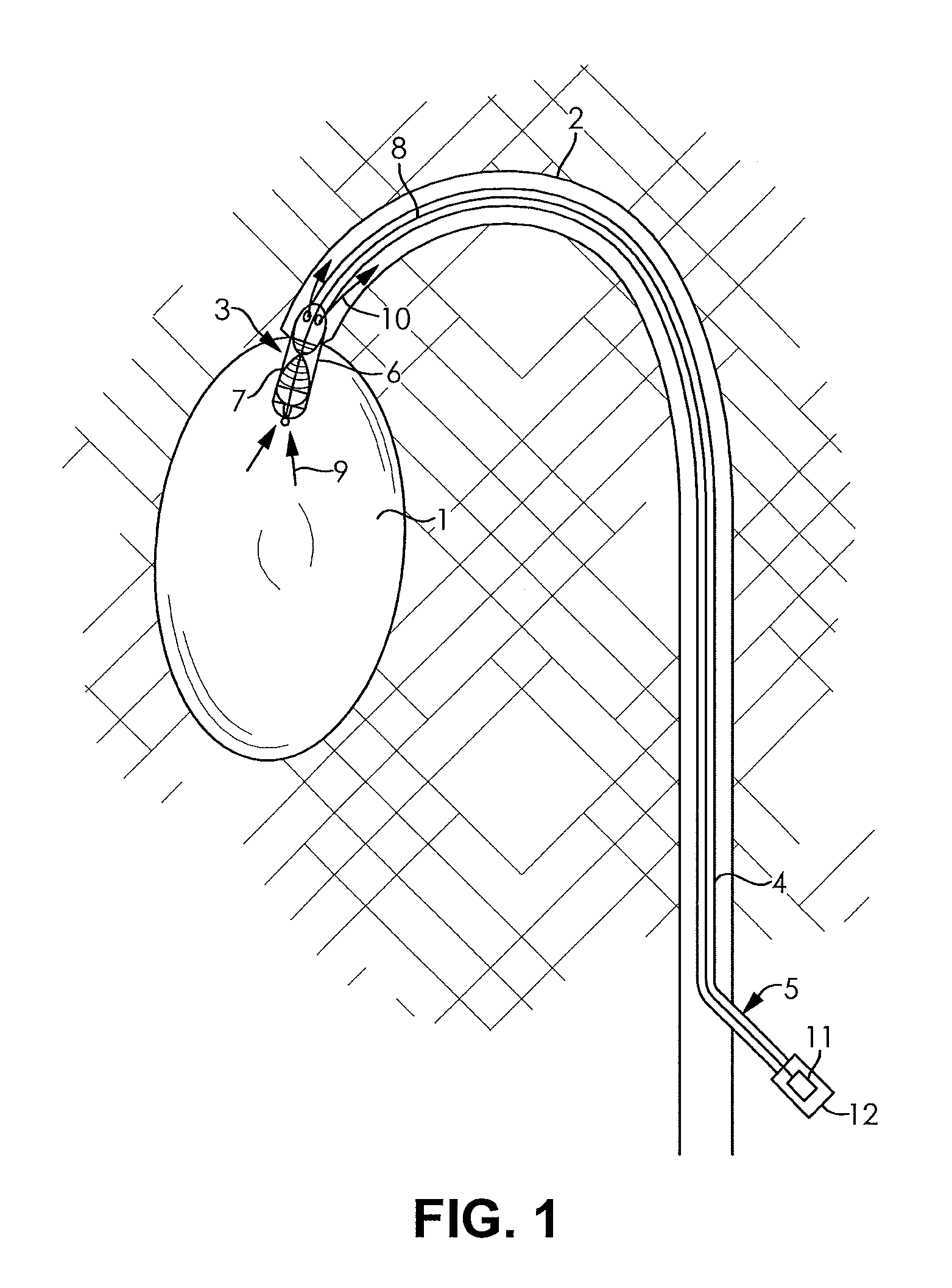 Fluid pump changeable in diameter, in particular for medical application