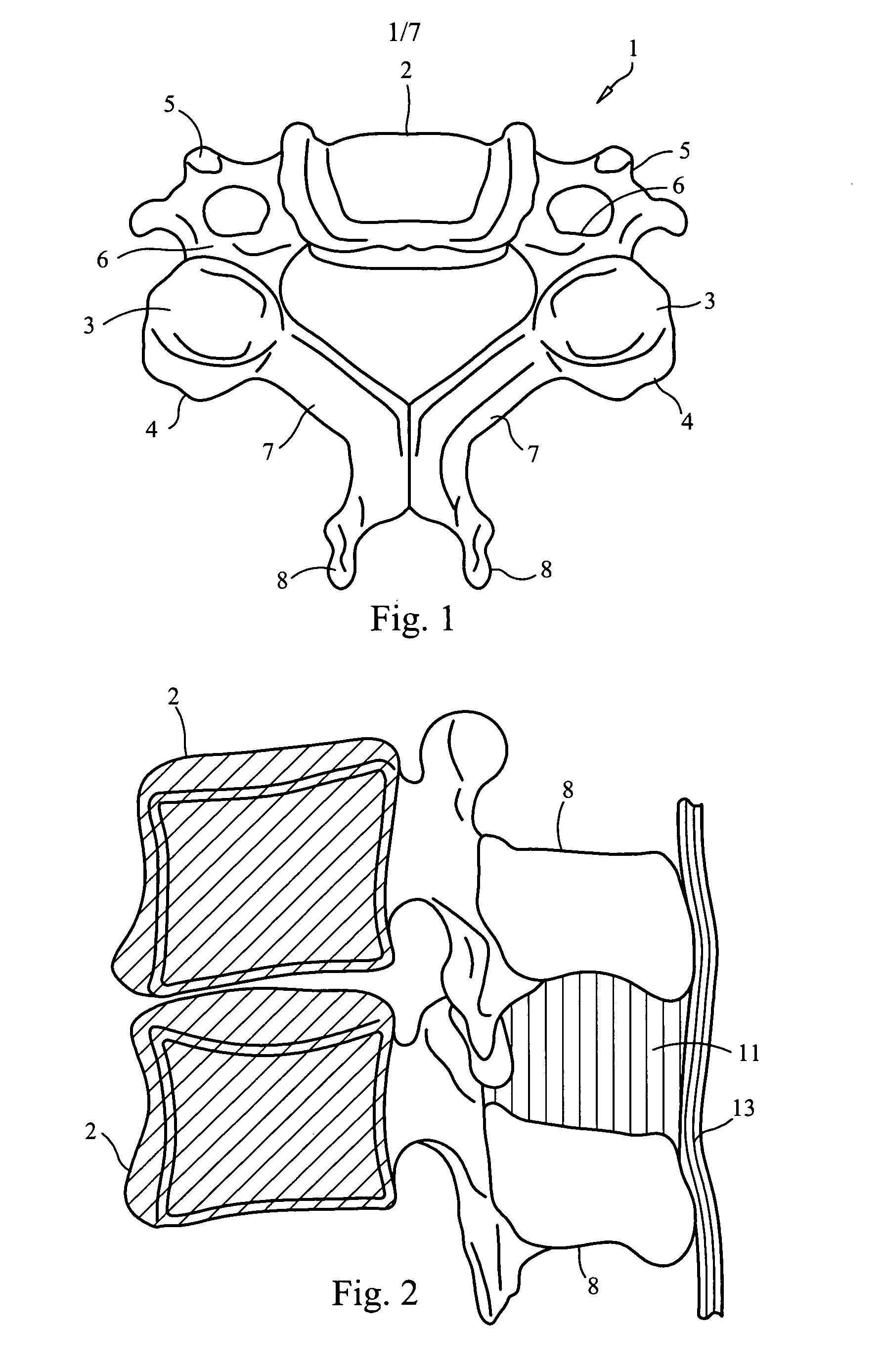 Interspinous dynamic stabilization implant and method of implanting