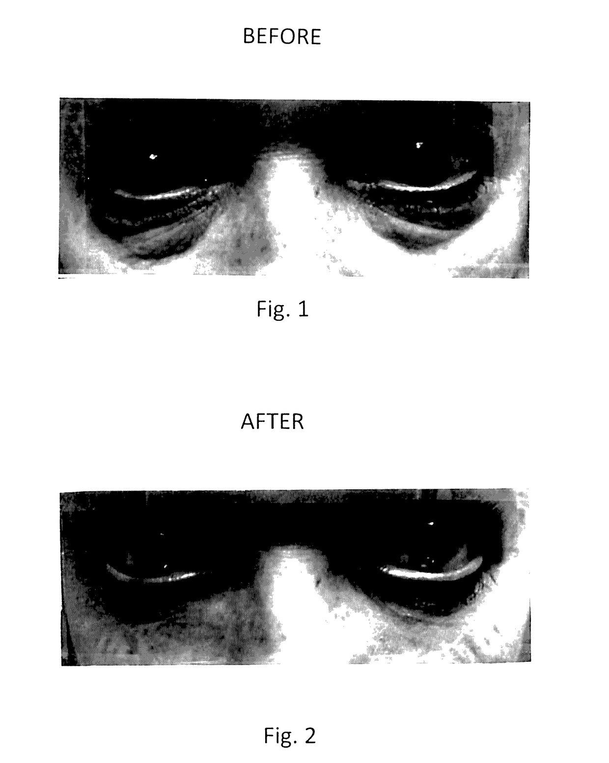 Topical composition for skin treatment to reduce lines and wrinkles of the face and body using a dual DNA repair mechanism to address damage caused by aging and ultra-voilet induced damage to the skin with combination of skin turgor enhancement compounds