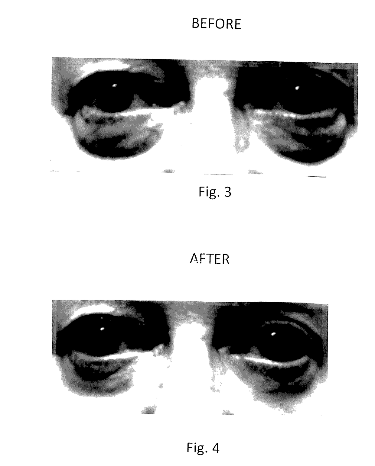 Topical composition for skin treatment to reduce lines and wrinkles of the face and body using a dual DNA repair mechanism to address damage caused by aging and ultra-voilet induced damage to the skin with combination of skin turgor enhancement compounds