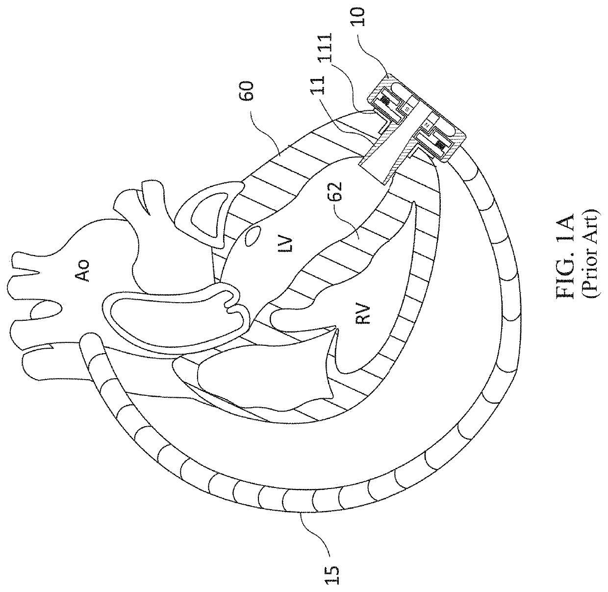 Sutureless inflow cannula assembly for connecting ventricular assist devices to human circulation