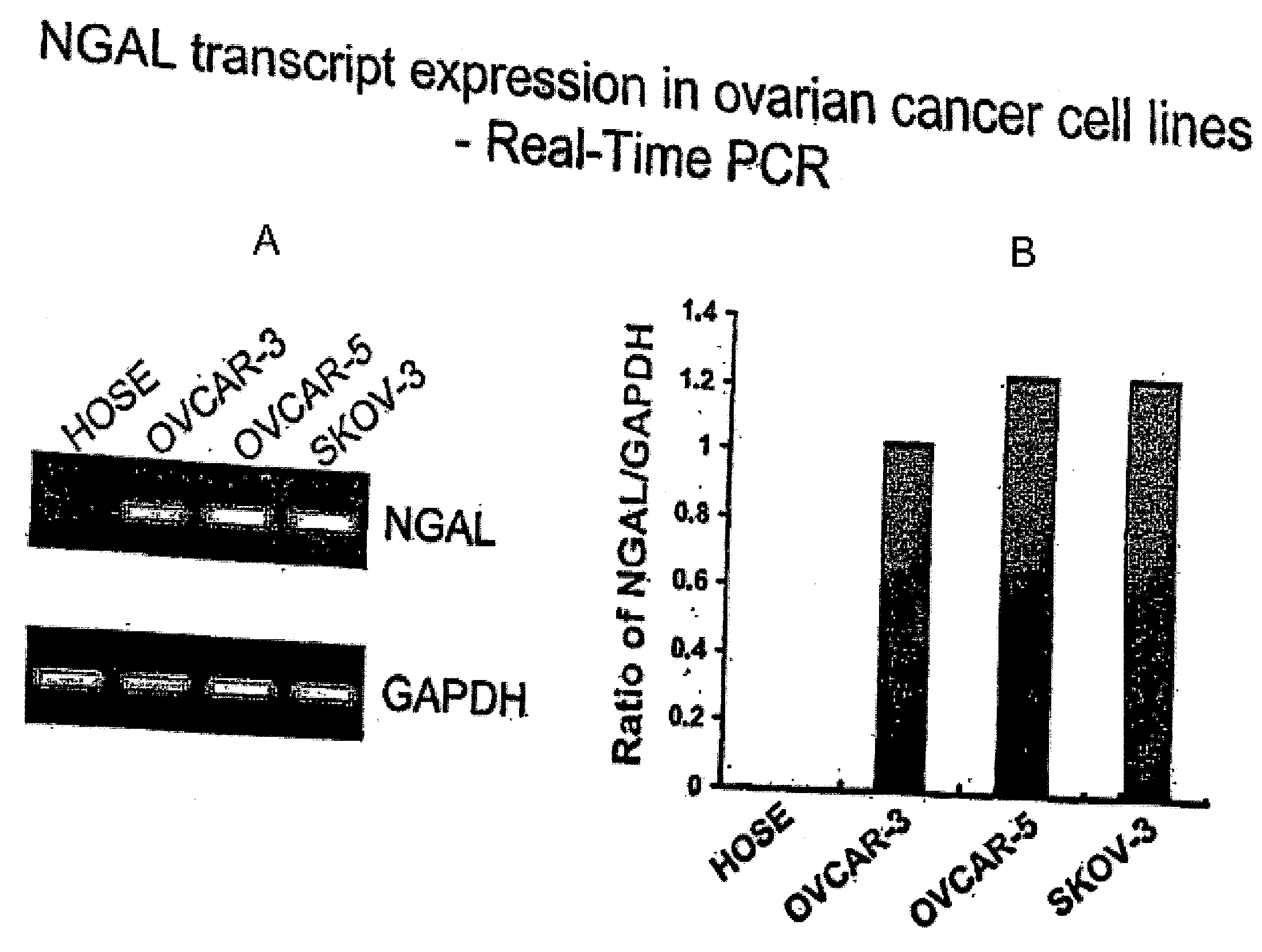 Free ngal as a biomarker for cancer