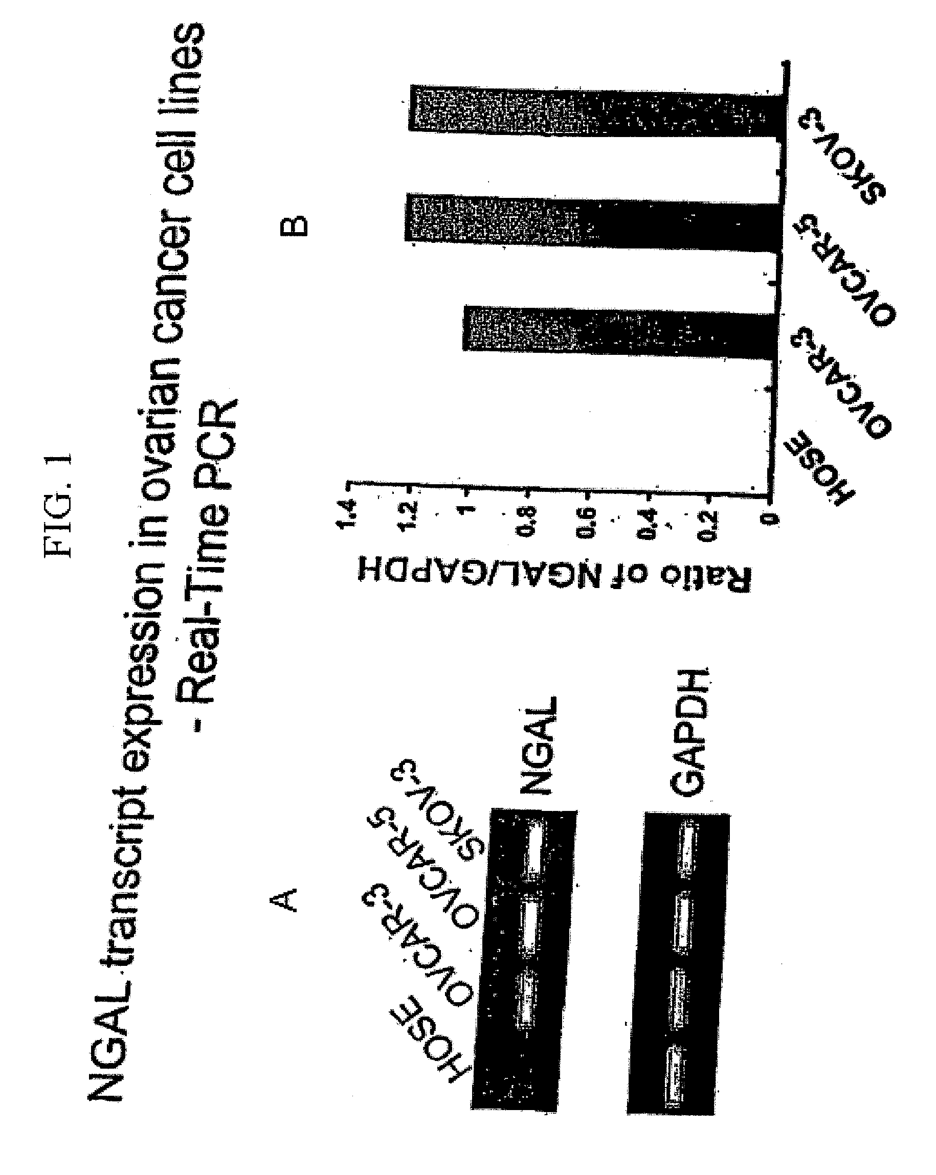 Free ngal as a biomarker for cancer