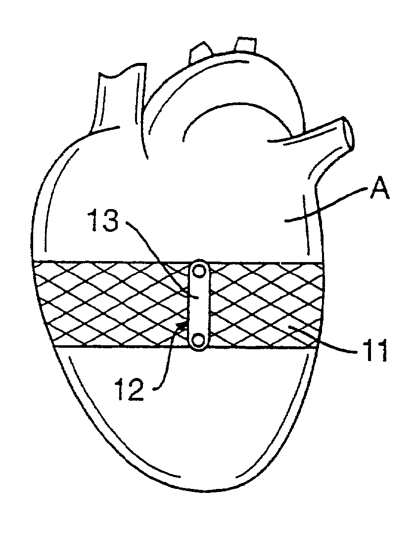 Heart wall tension reduction apparatus and method