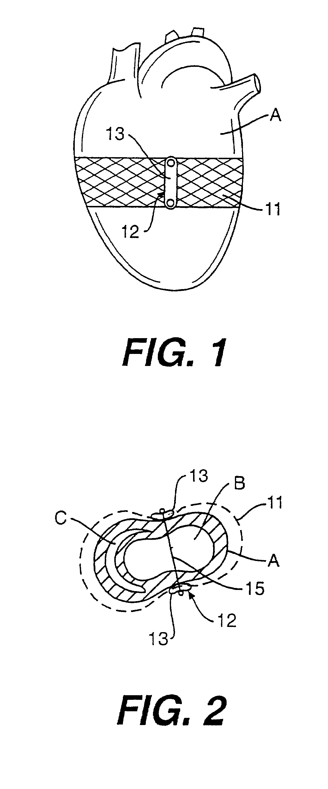 Heart wall tension reduction apparatus and method