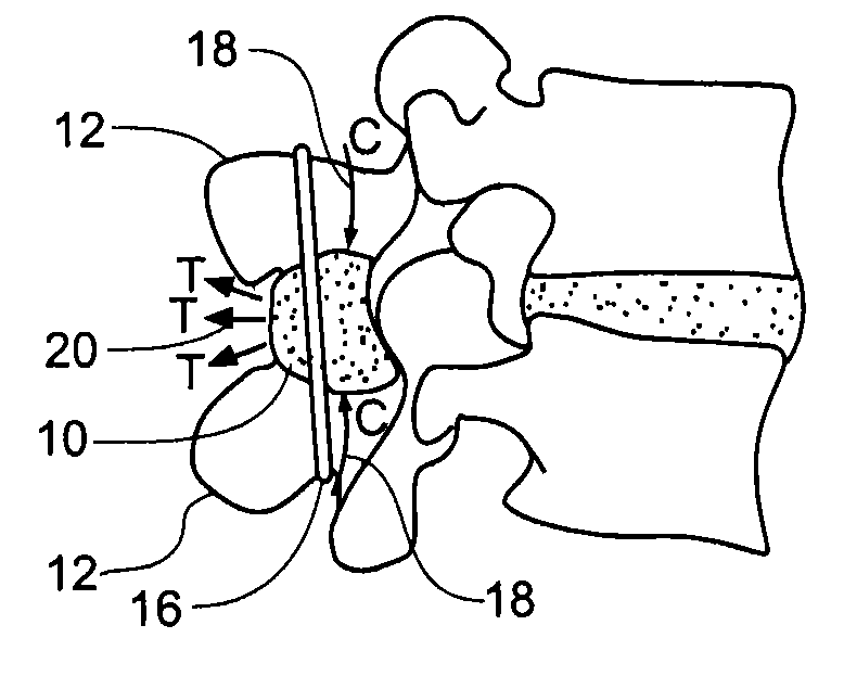 Method and device for interspinous process fusion