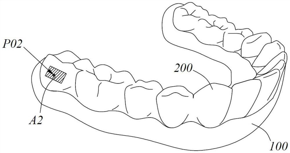 Construction method and system of retention accessory and bracket-free invisible orthodontic appliance