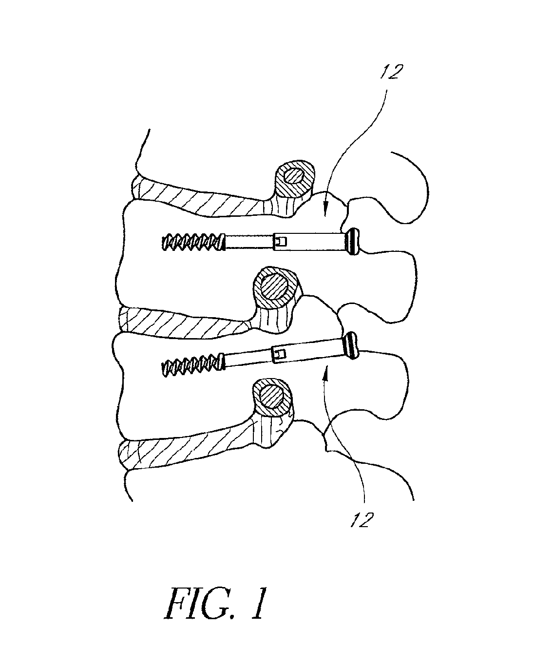 Method and apparatus for spinal fixation