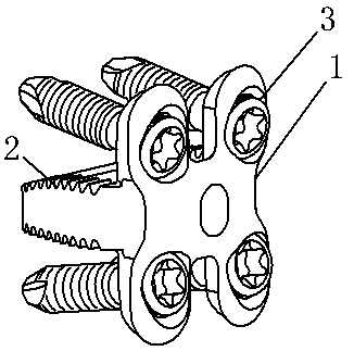 Embedded anterior cervical compression fusion fixing device