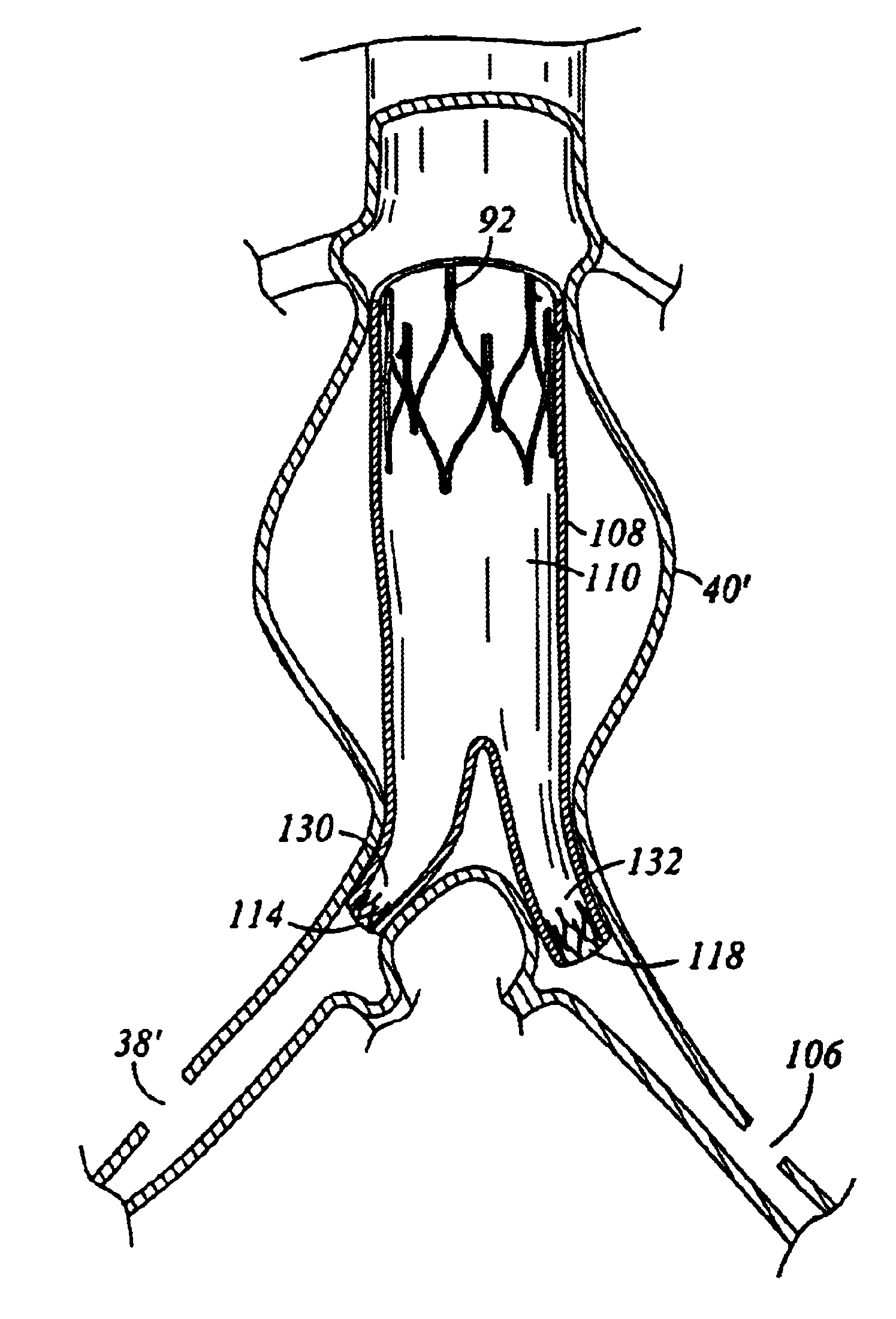 Device and method for staged implantation of a graft for vascular repair