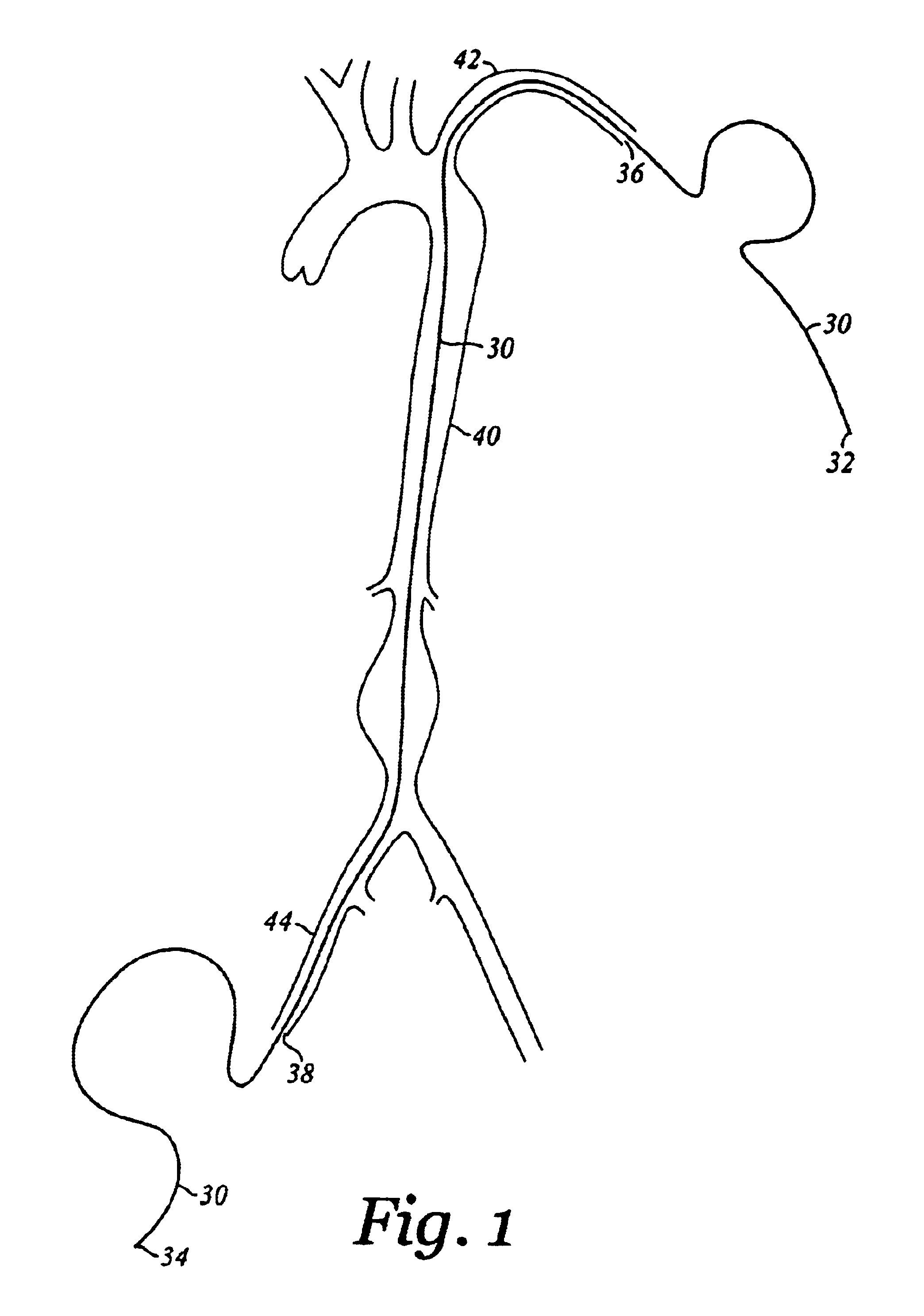 Device and method for staged implantation of a graft for vascular repair