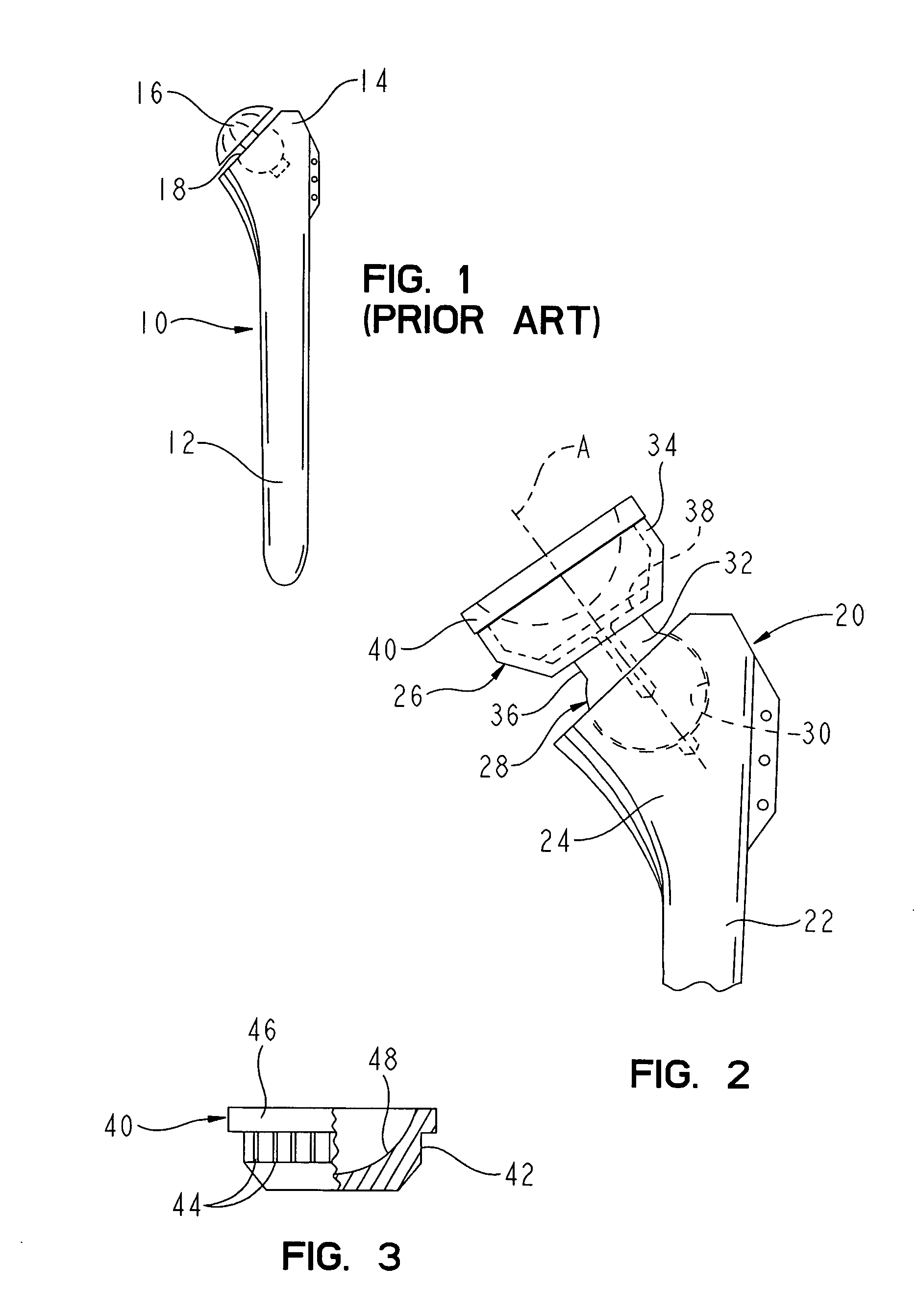 Reverse-type humeral prosthesis