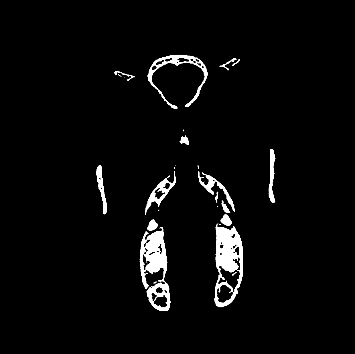 Sparse Angle Reconstruction Method and Device of CT Image Based on Total Curvature Joint Total Variation