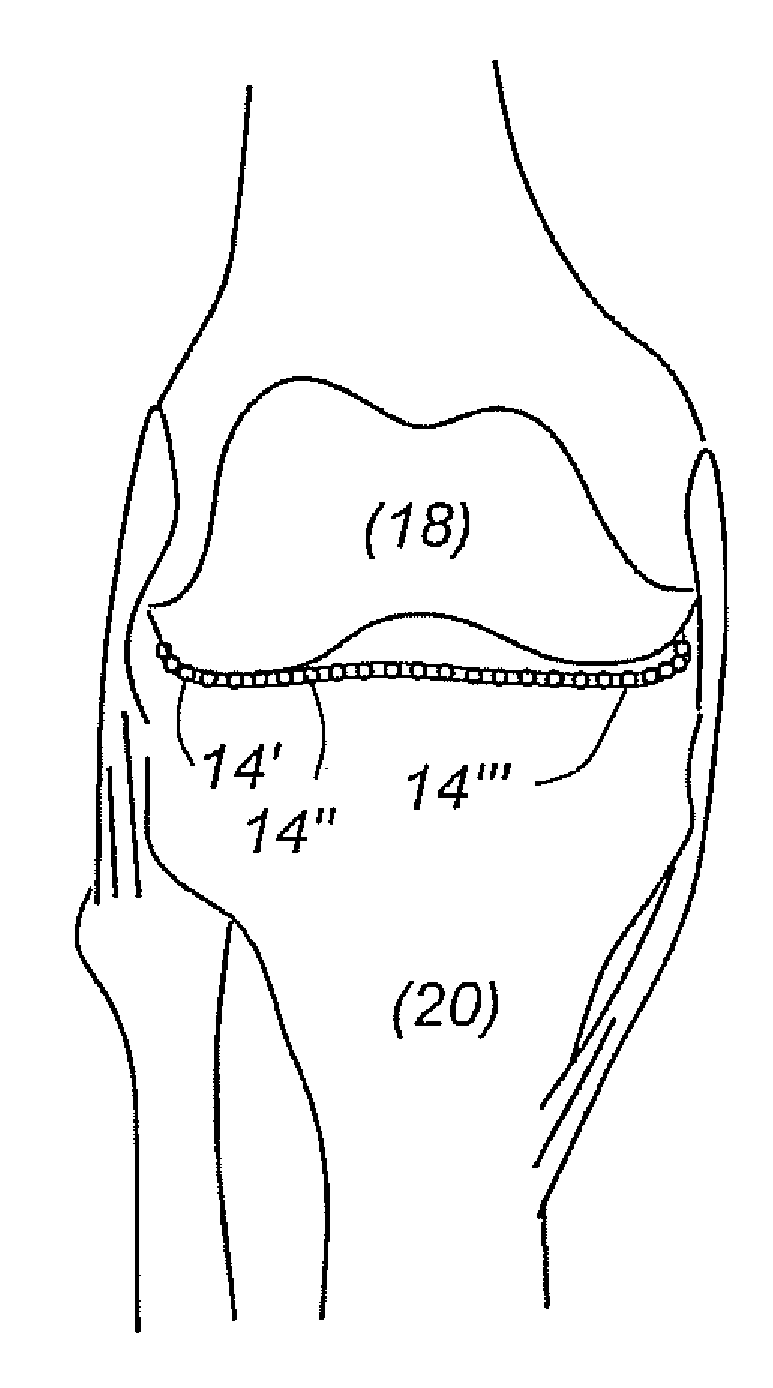 Prosthesis for replacement of cartilage