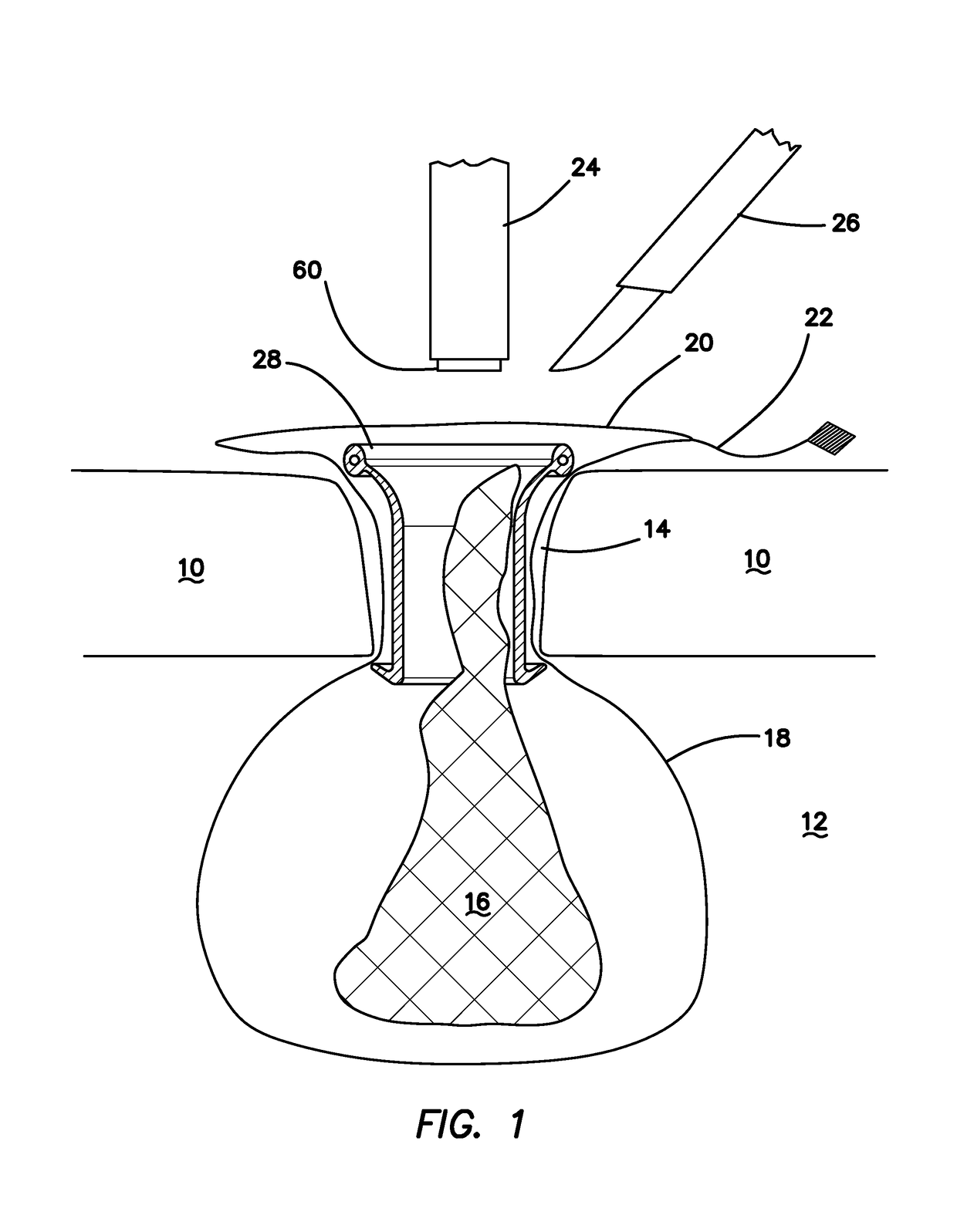 System and methods for tissue removal