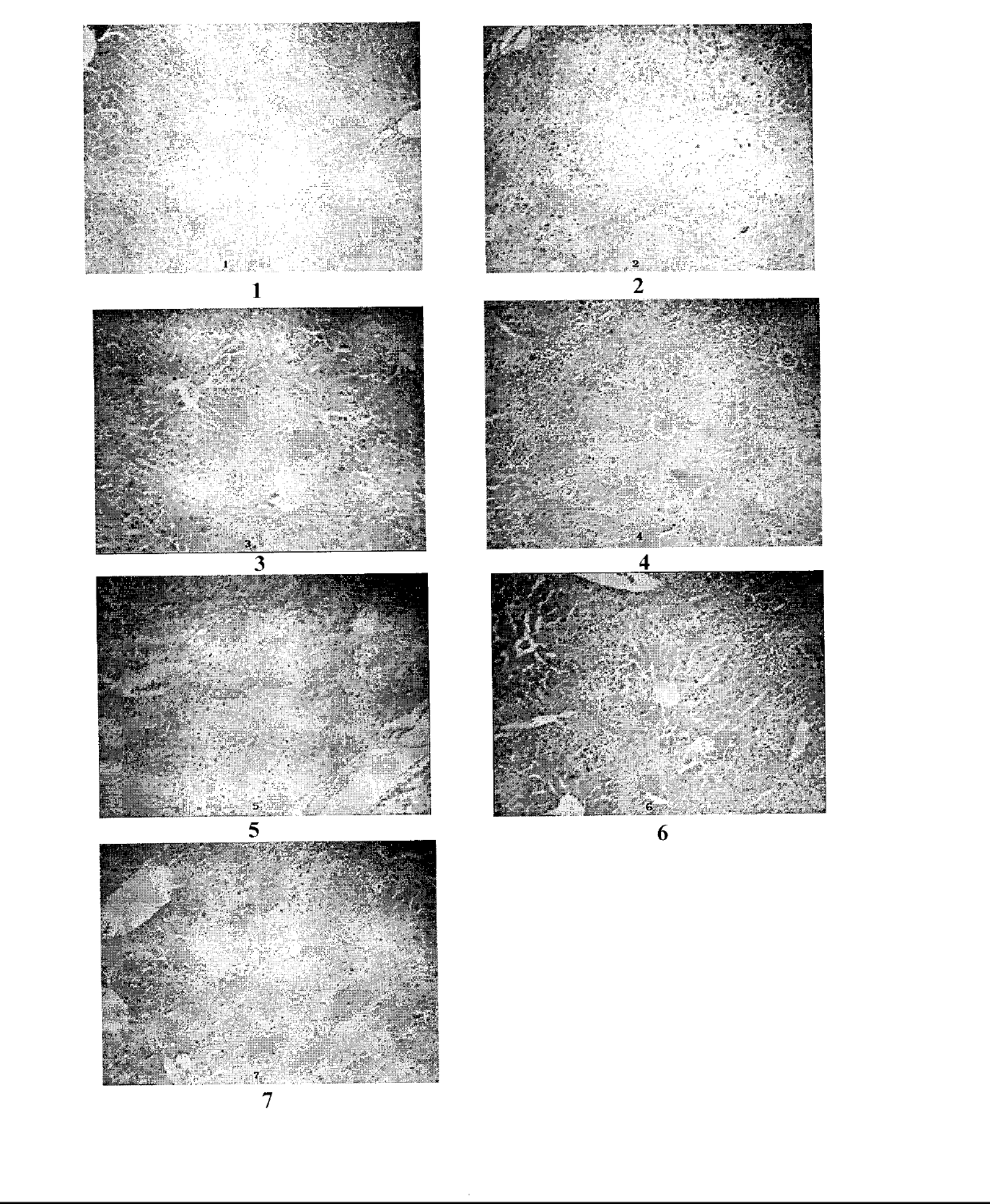 Compound medicament for treating chronic liver disease and preparation method thereof