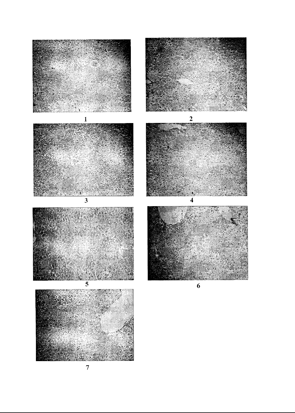 Compound medicament for treating chronic liver disease and preparation method thereof