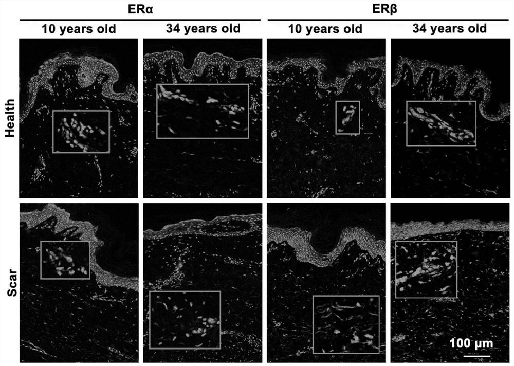 Method for obtaining treatment target causing skin keloids