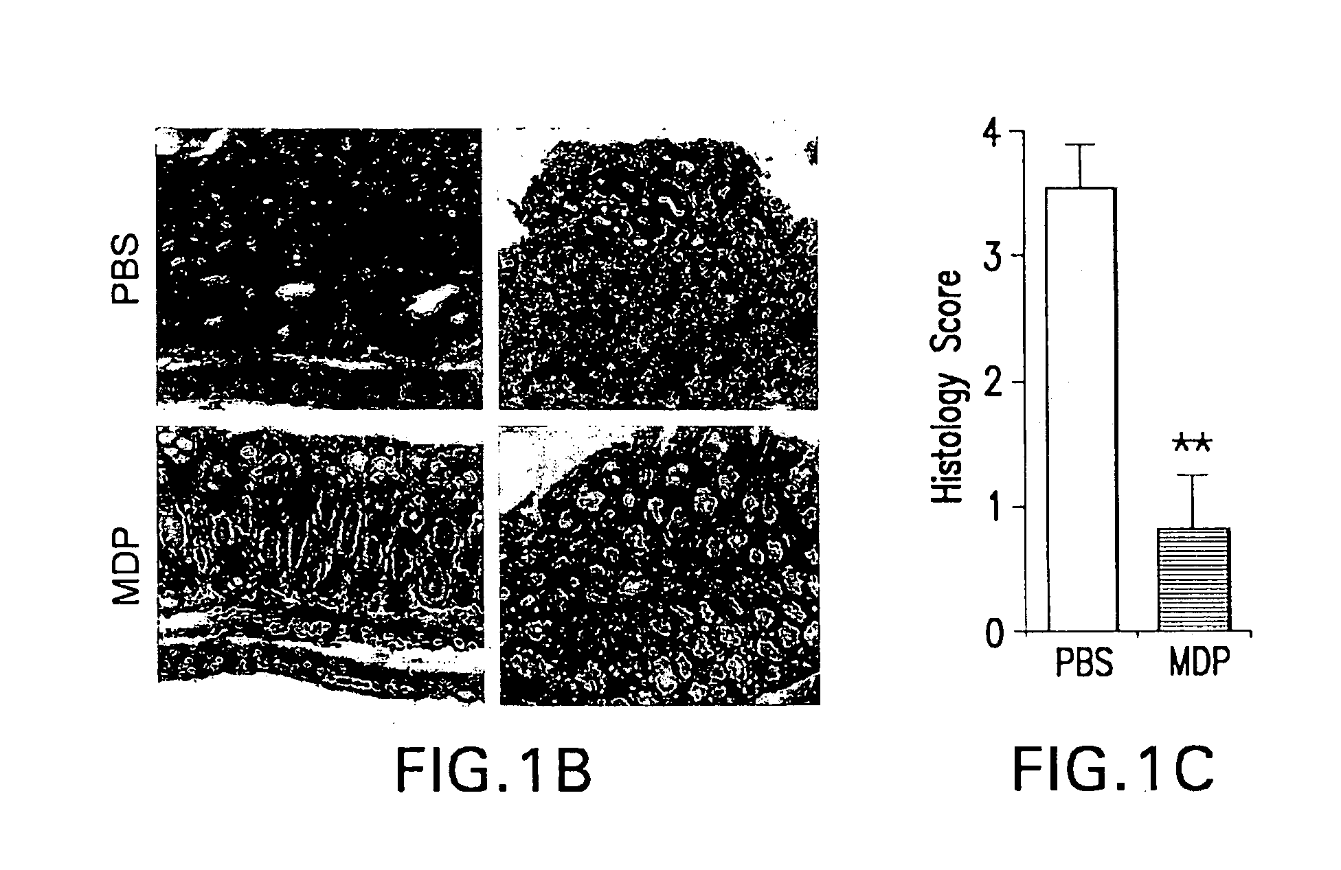 Use of muramyl dipeptide (MDP) for treating inflammation