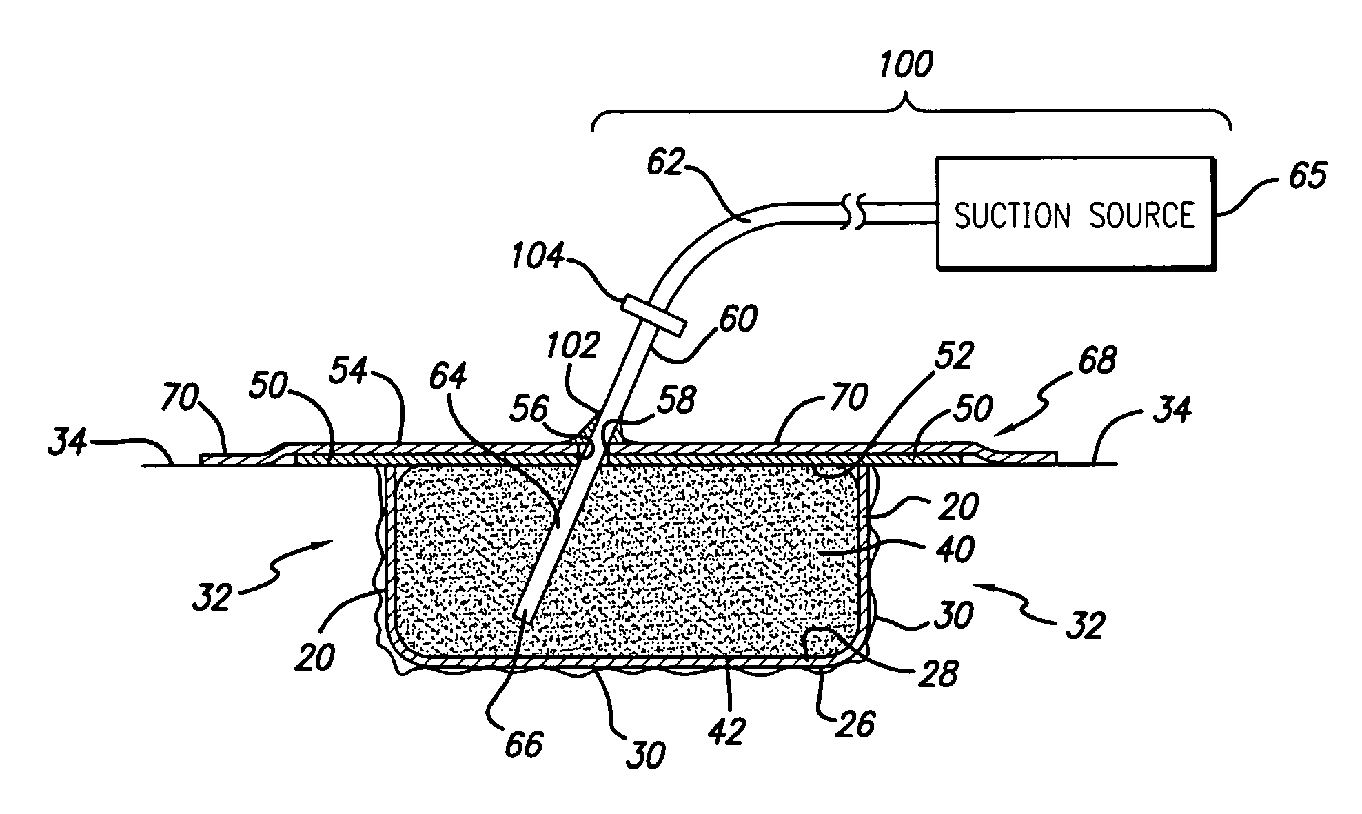 Laminar construction negative pressure wound dressing including bioabsorbable material