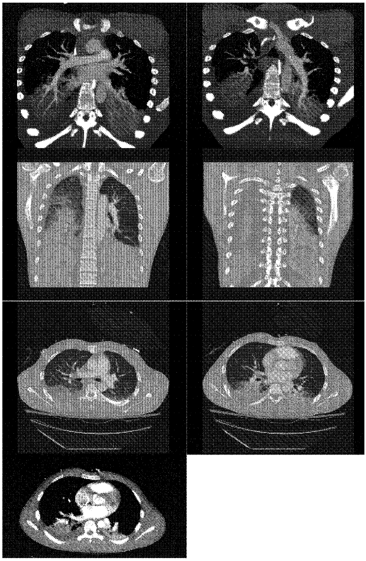 Use of levocetirizine and montelukast in the treatment of traumatic injury