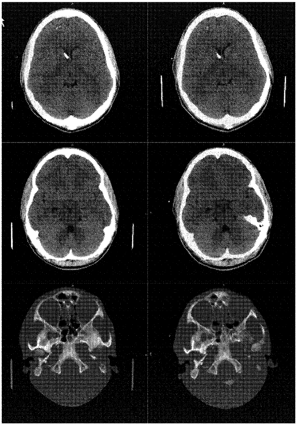 Use of levocetirizine and montelukast in the treatment of traumatic injury