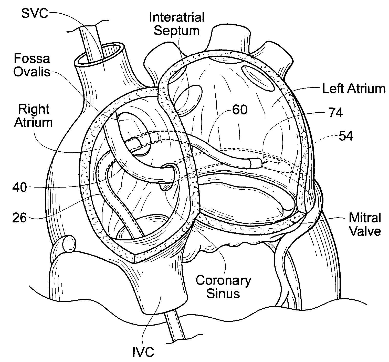 Devices, systems, and methods for reshaping a heart valve annulus