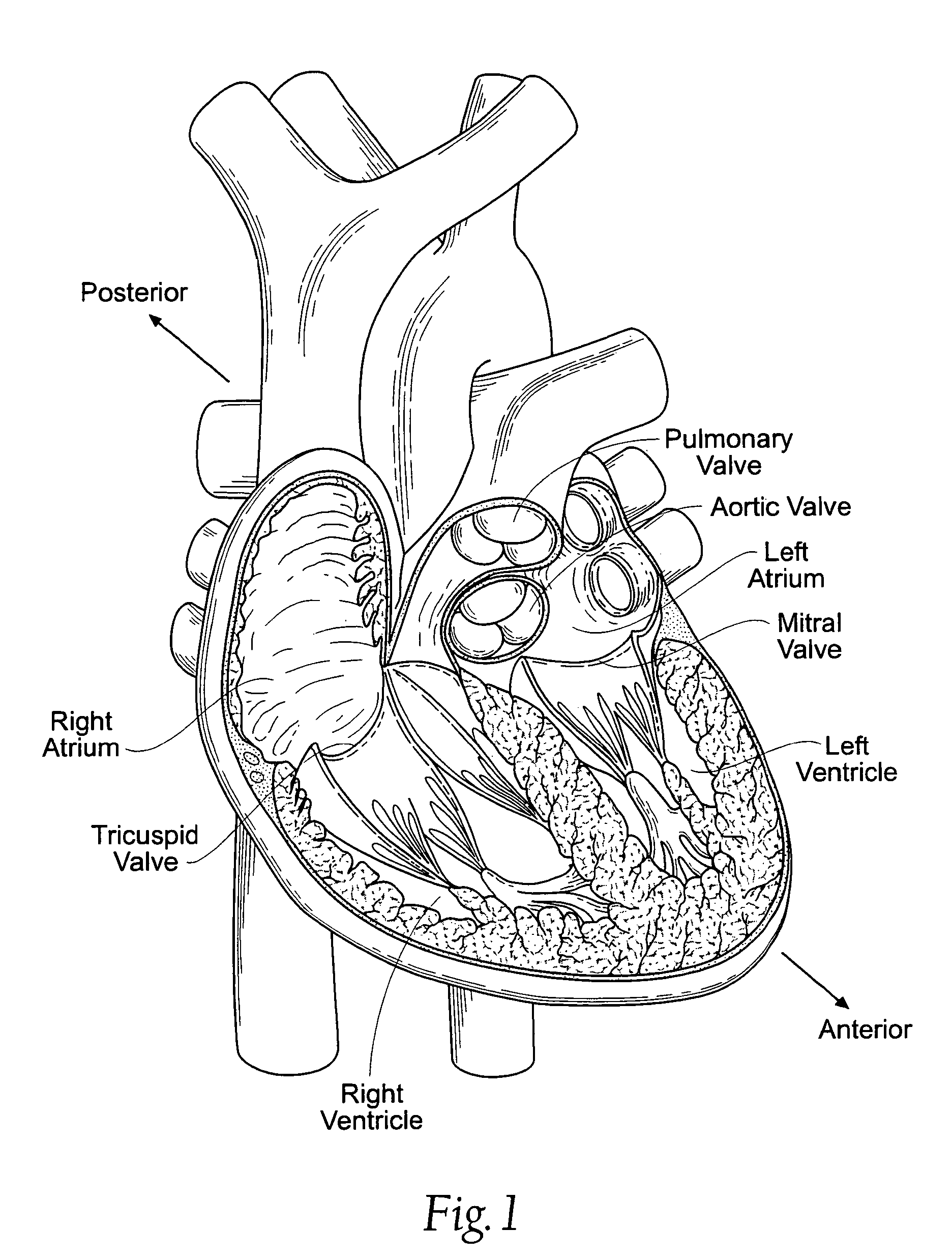 Devices, systems, and methods for reshaping a heart valve annulus