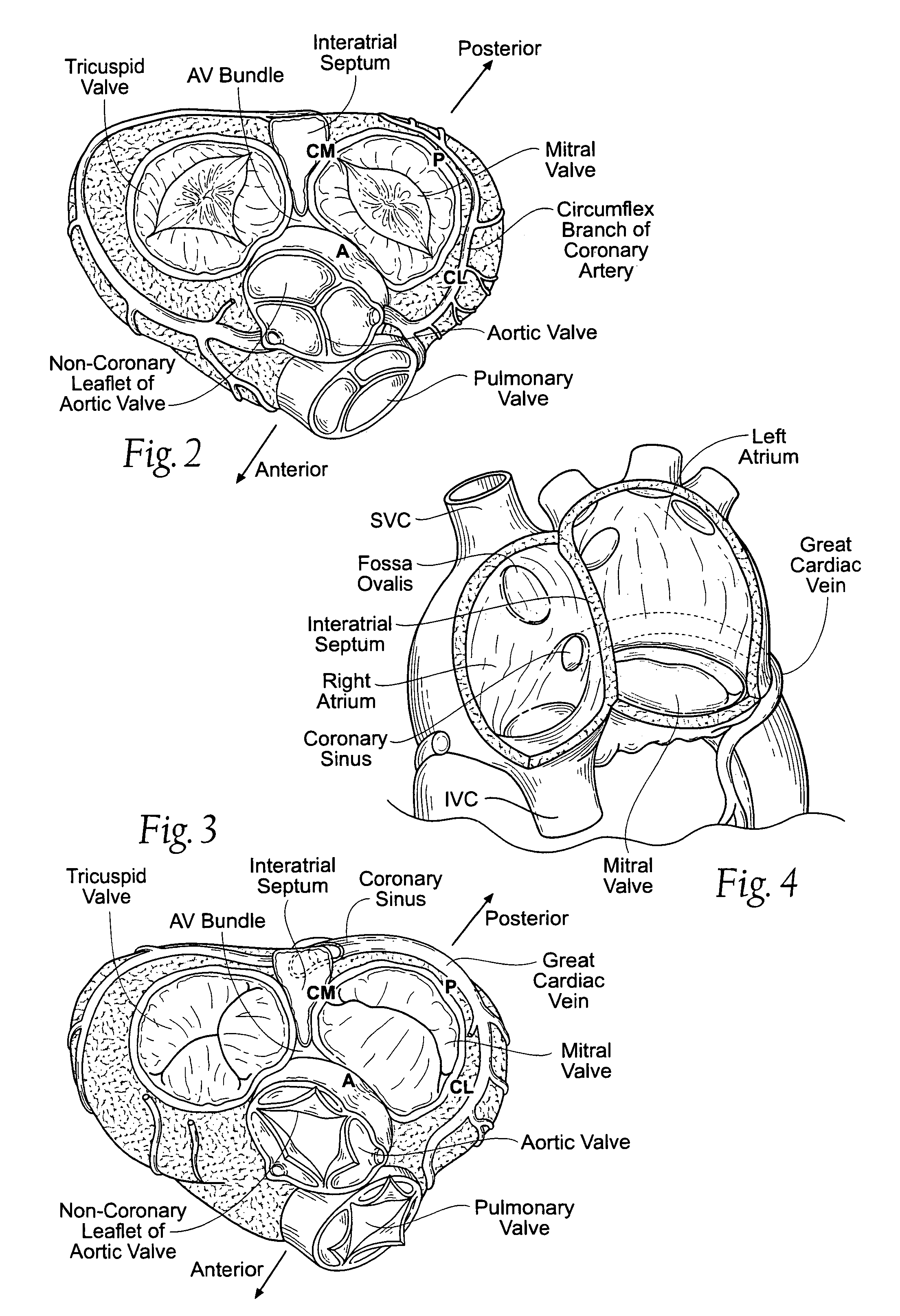 Devices, systems, and methods for reshaping a heart valve annulus