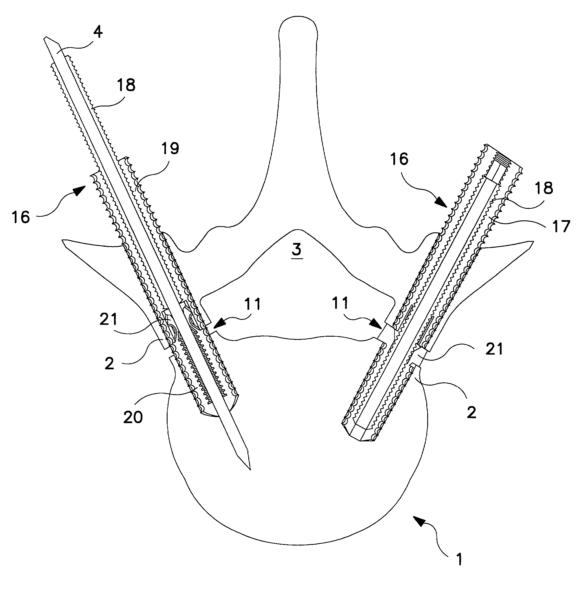 Percutaneous technique and implant for expanding the spinal canal