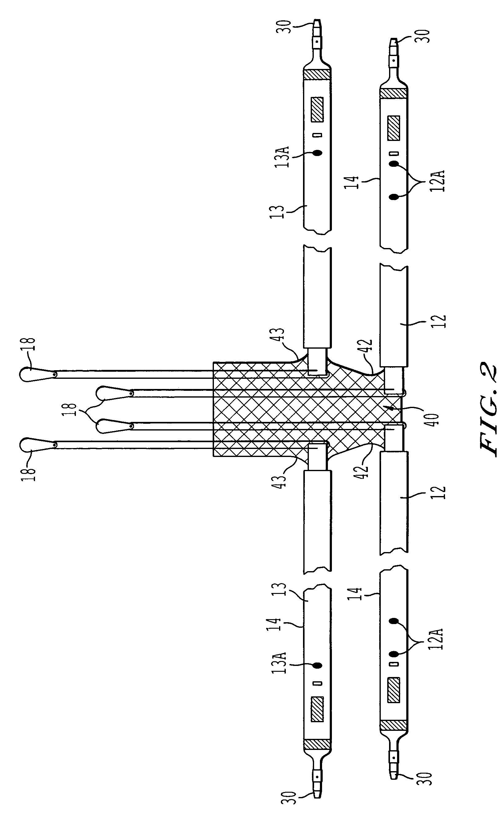 Method and apparatus for cystocele repair