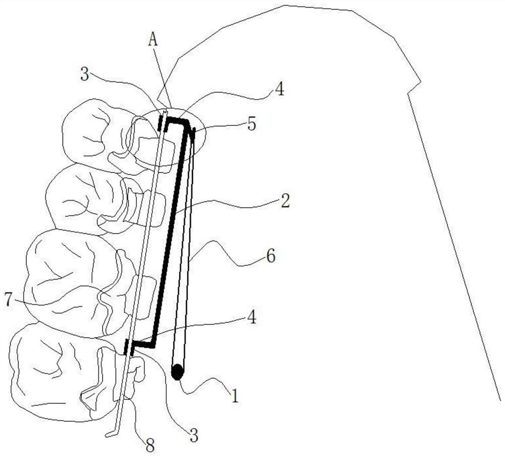 Molar distalization correcting device