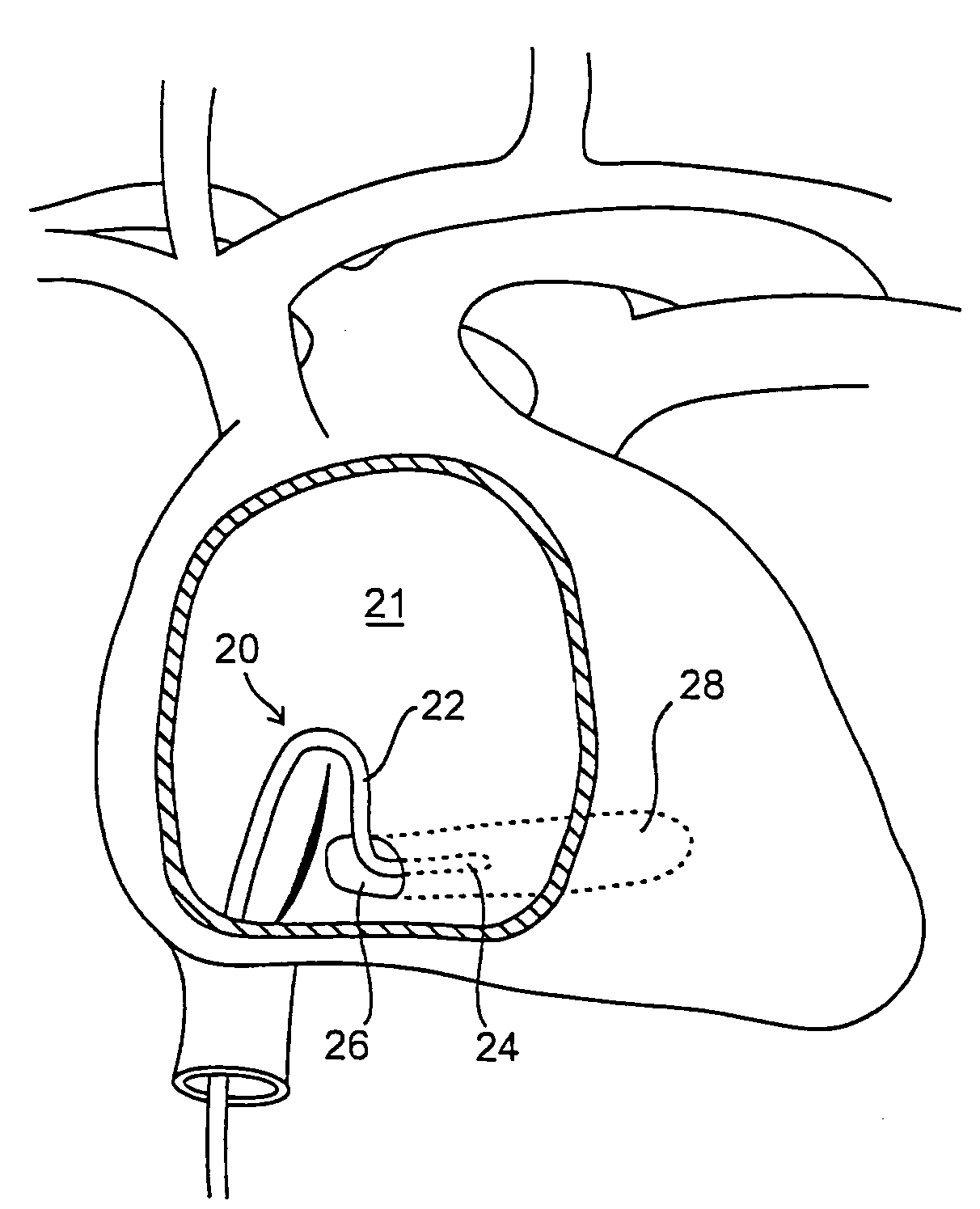 Methods and devices for retrieval of a medical agent from a physiological efferent fluid collection site