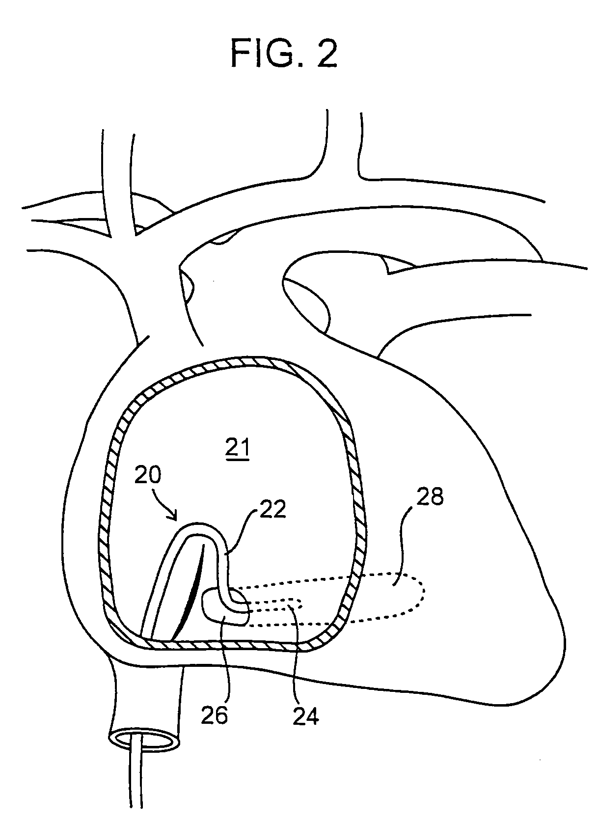 Methods and devices for retrieval of a medical agent from a physiological efferent fluid collection site