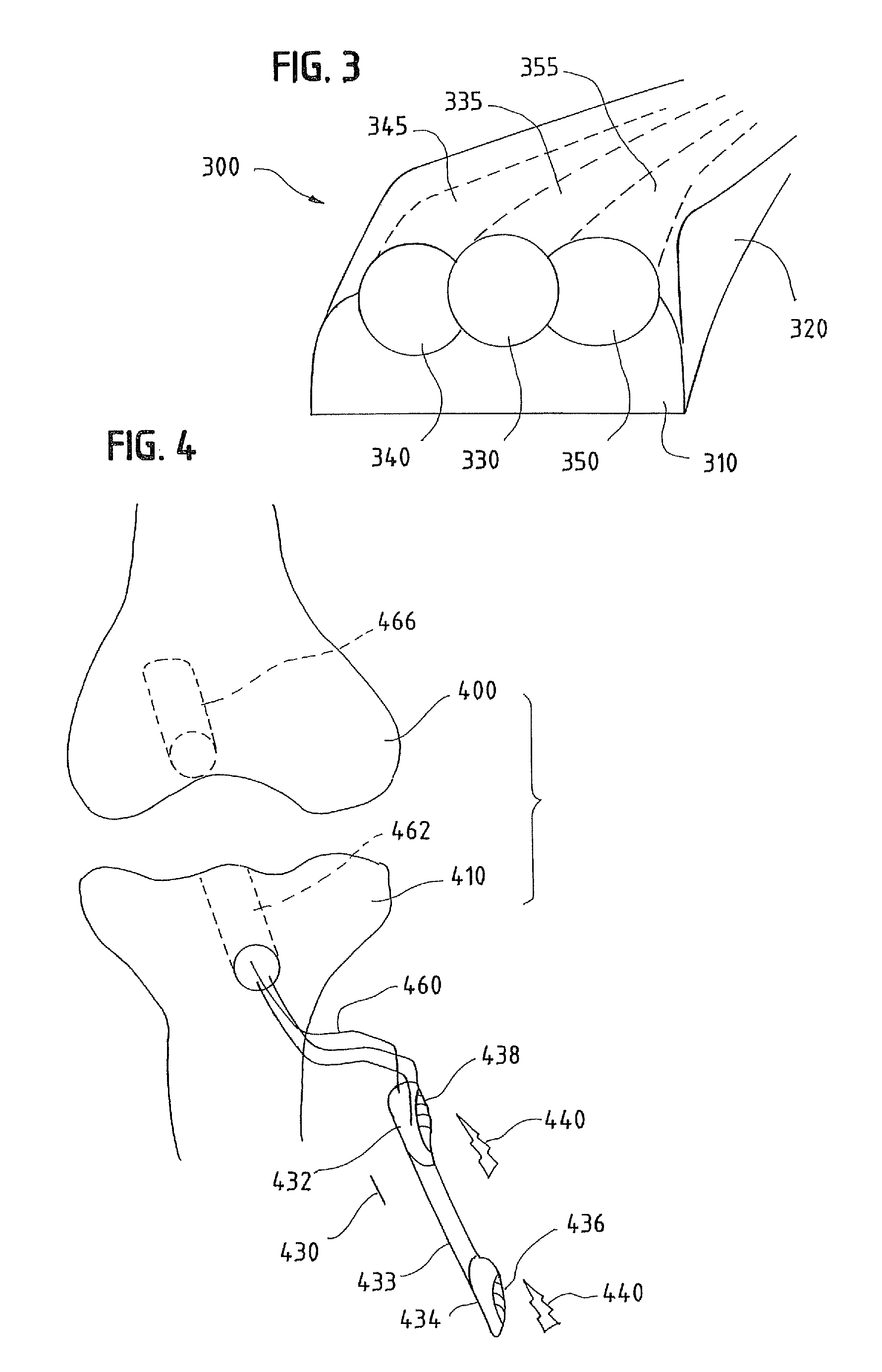 Materials and methods for improved bone tendon bone transplantation