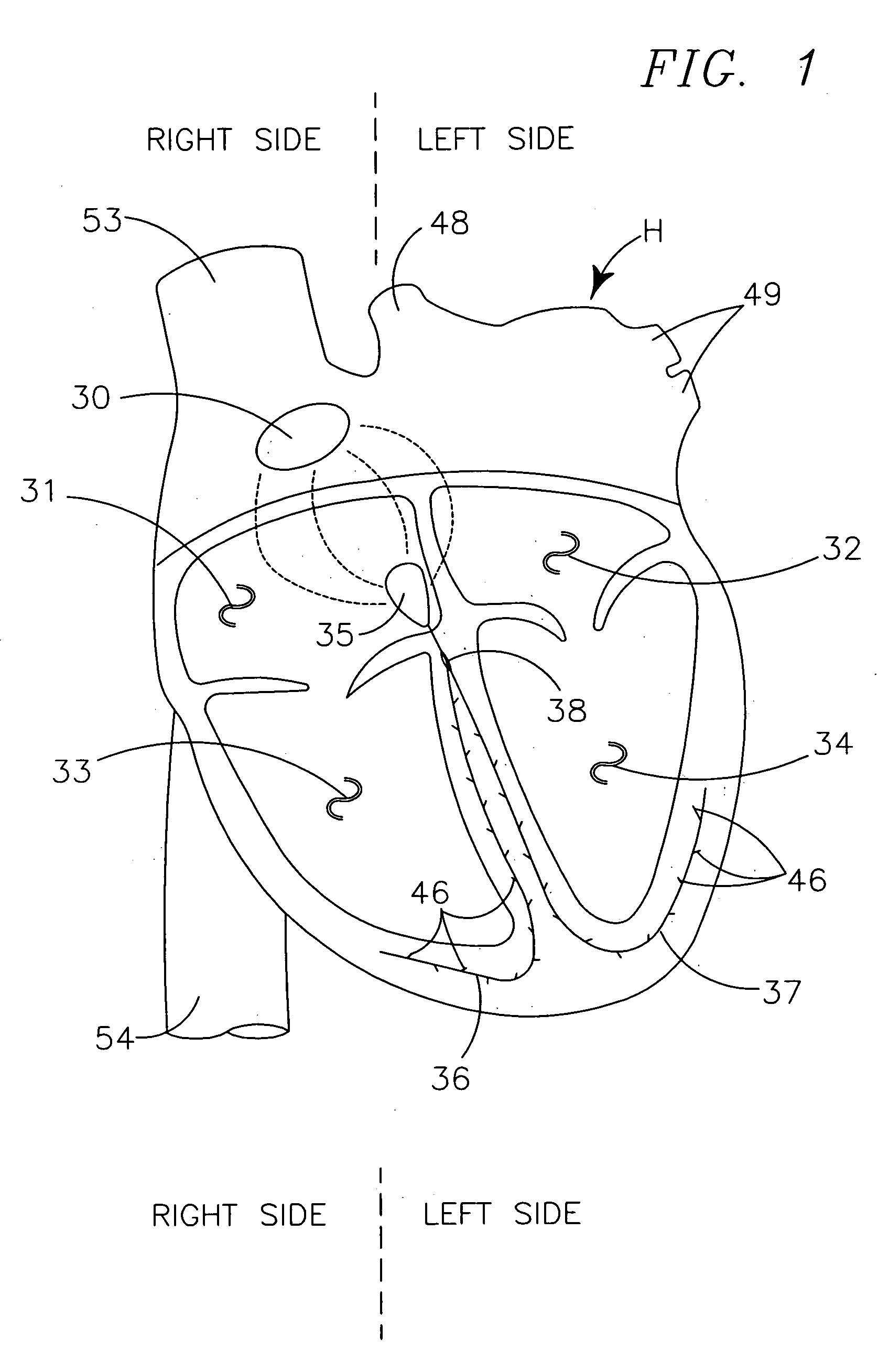 Method for optimizing CRT therapy