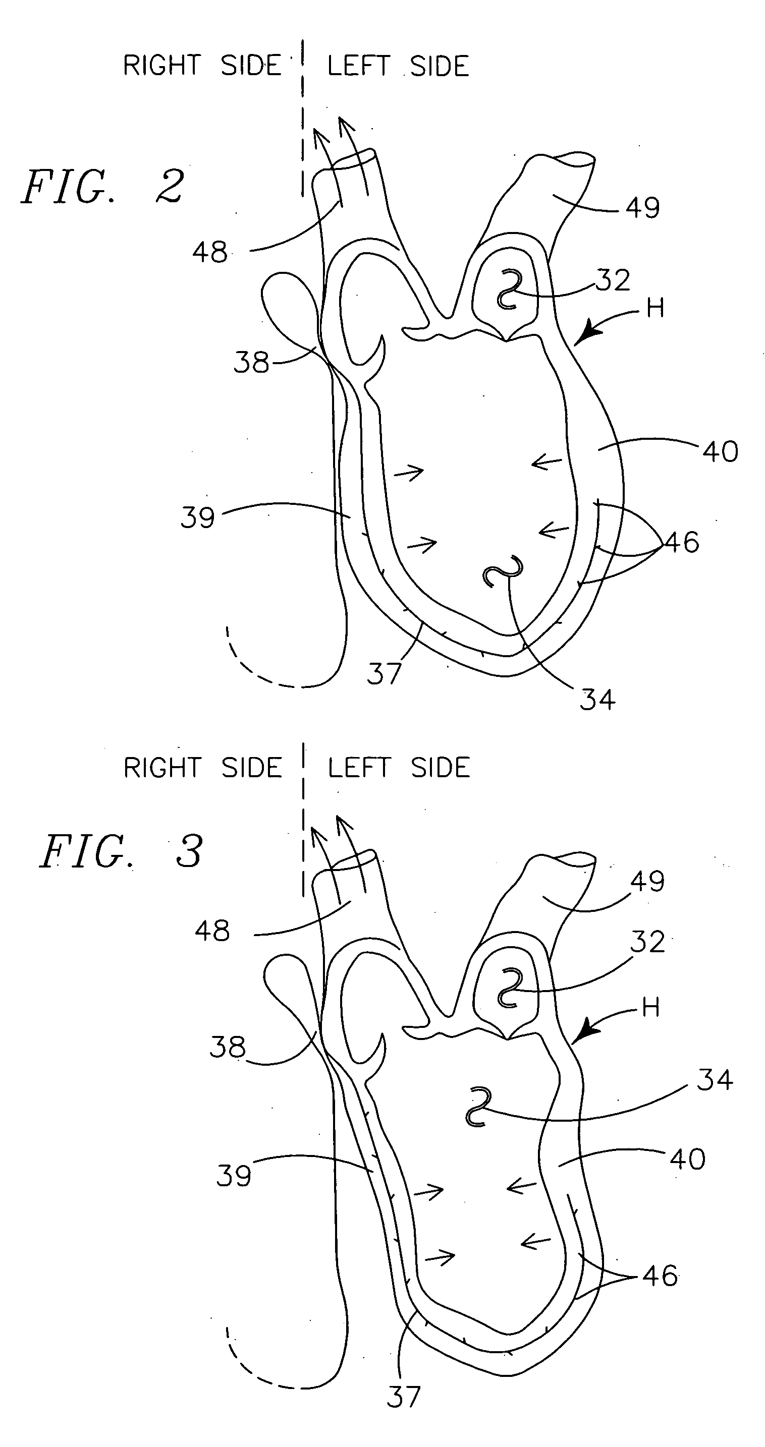 Method for optimizing CRT therapy