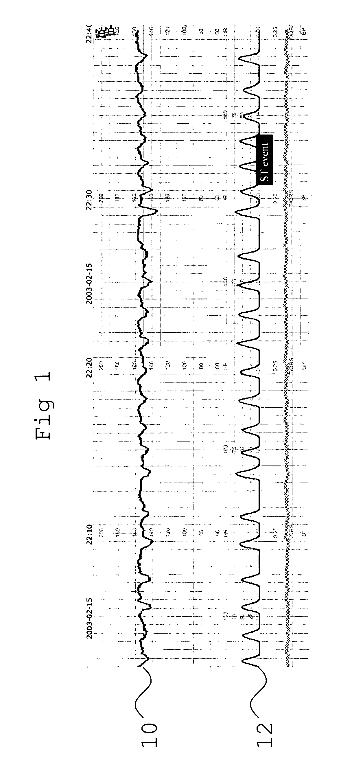 Assessment of Fetal Reactivity by Fetal Heart Rate Analysis