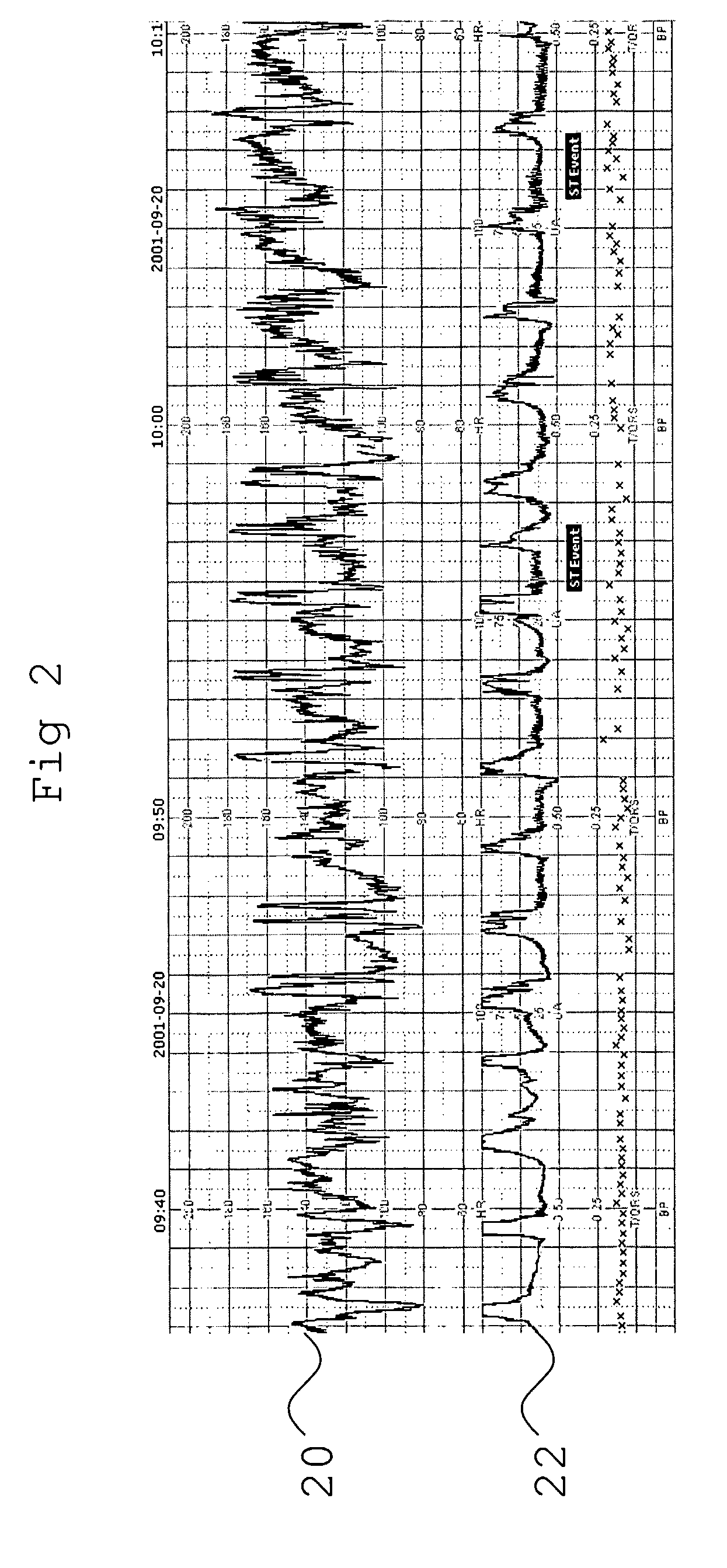 Assessment of Fetal Reactivity by Fetal Heart Rate Analysis