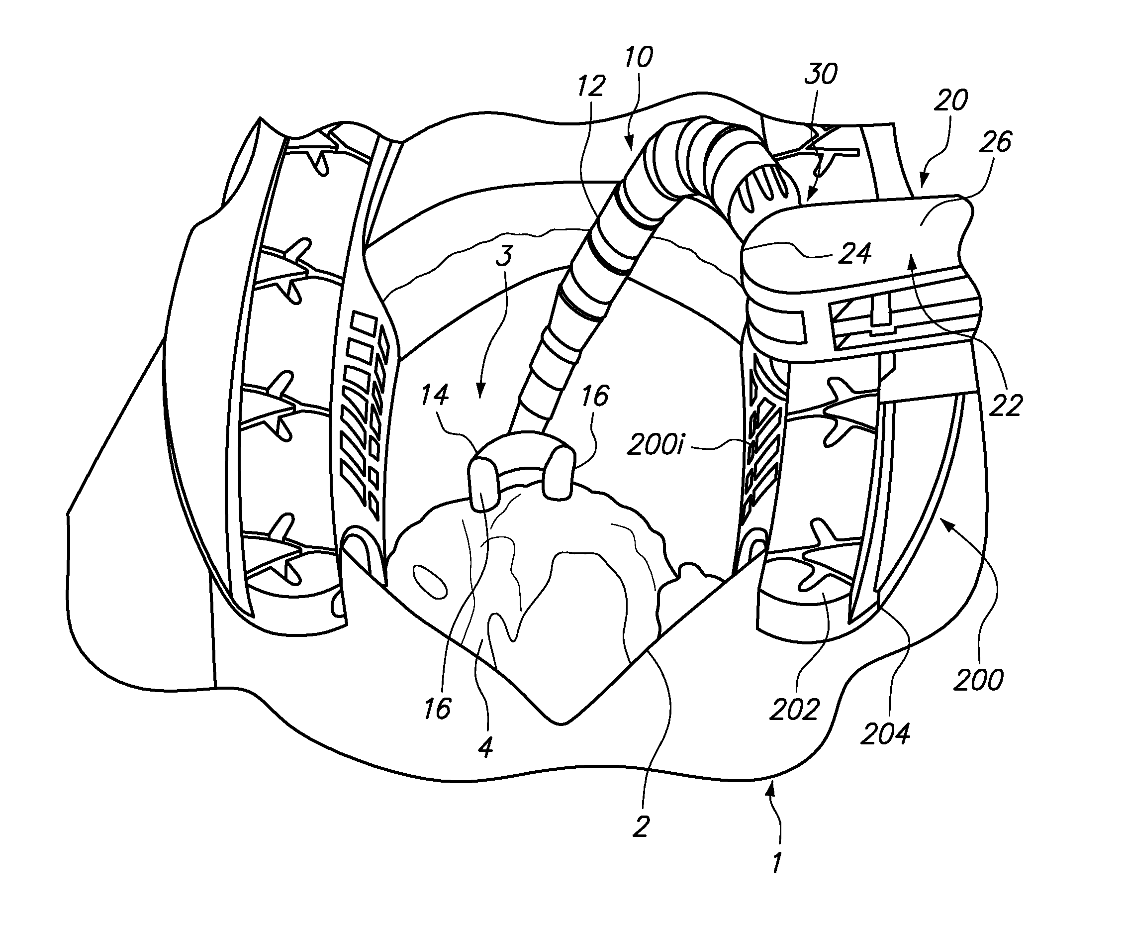 Surgical instruments, systems and methods of use