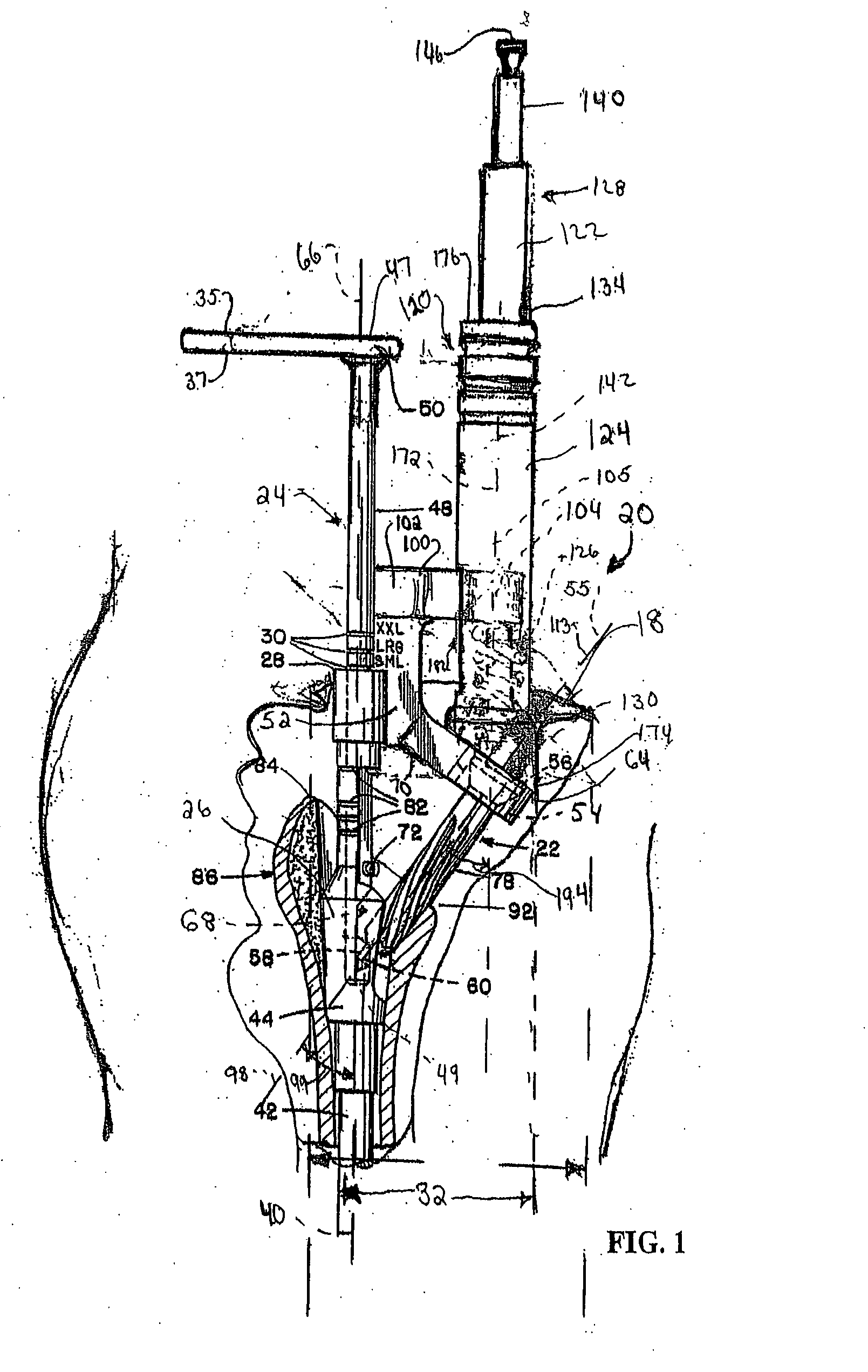 Minimally invasive bone miller apparatus