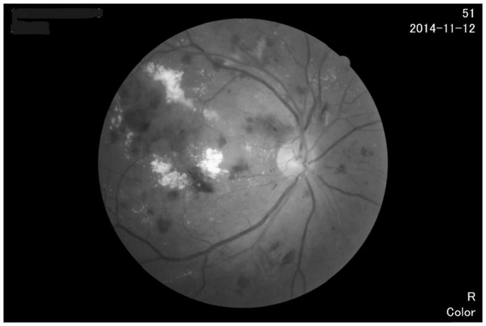 Fundus Retina Image Classification Method Based on Capsule Network