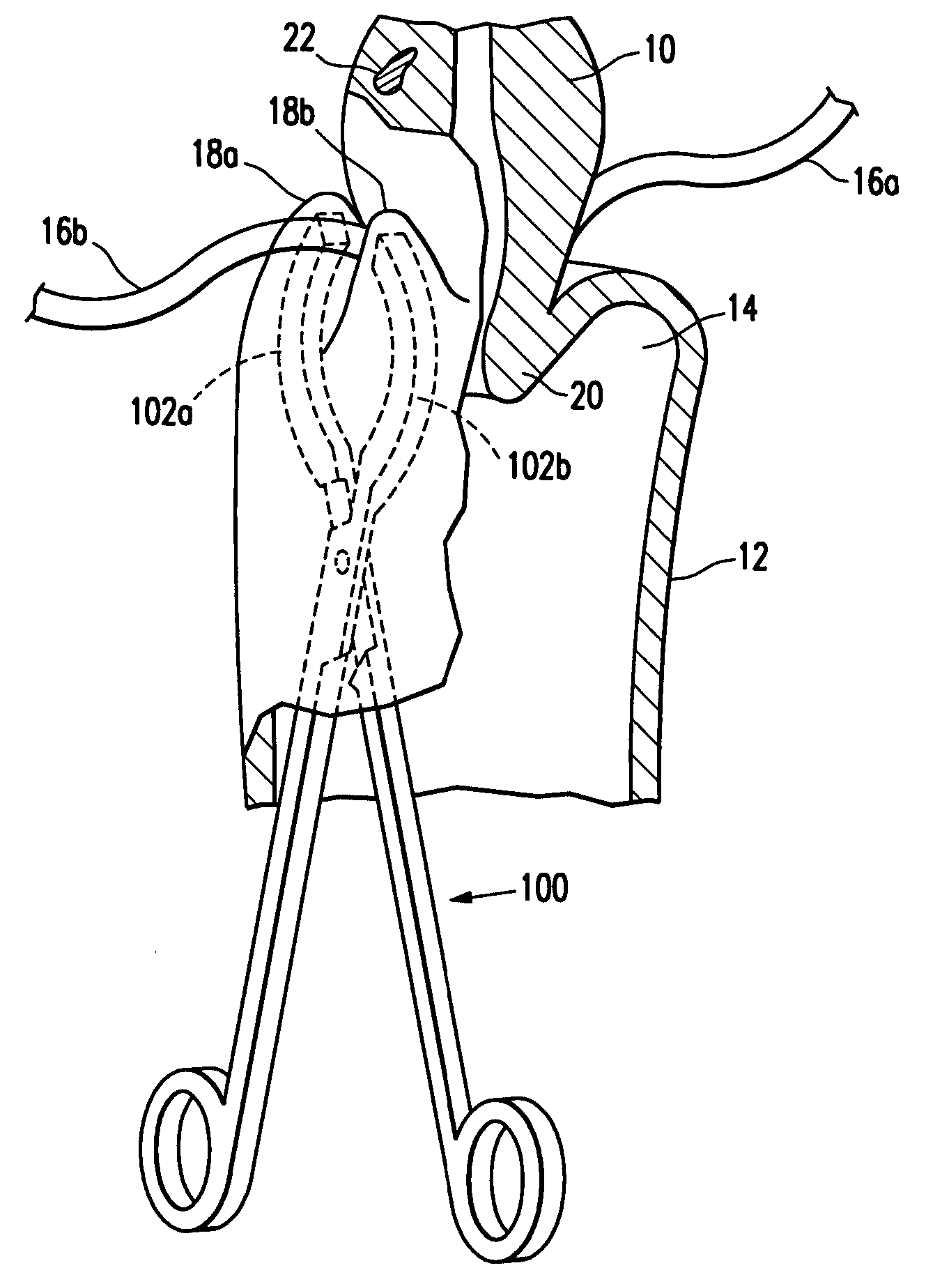 Methods for minimally invasive, non-permanent occlusion of a uterine artery