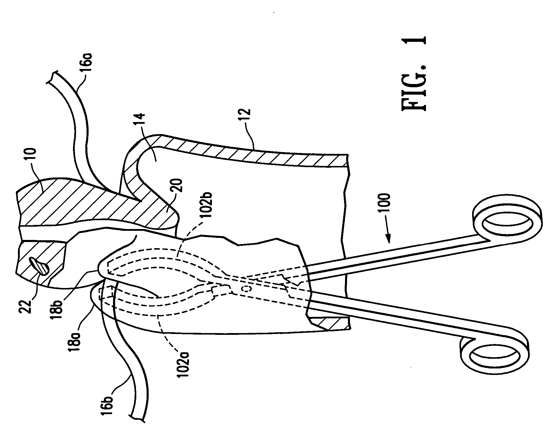 Methods for minimally invasive, non-permanent occlusion of a uterine artery