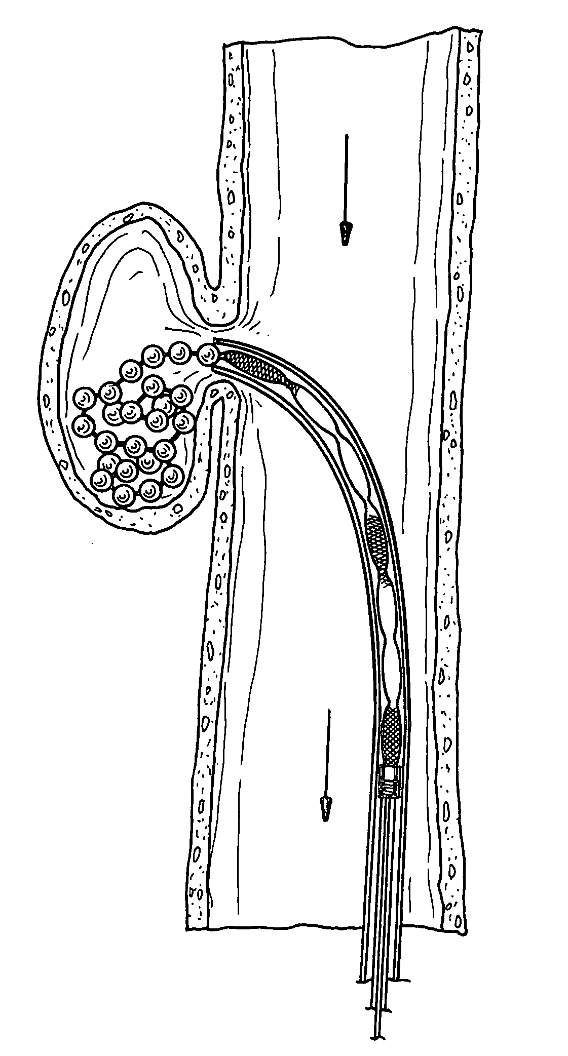 Braided occlusion device having repeating expanded volume segments separated by articulation segments